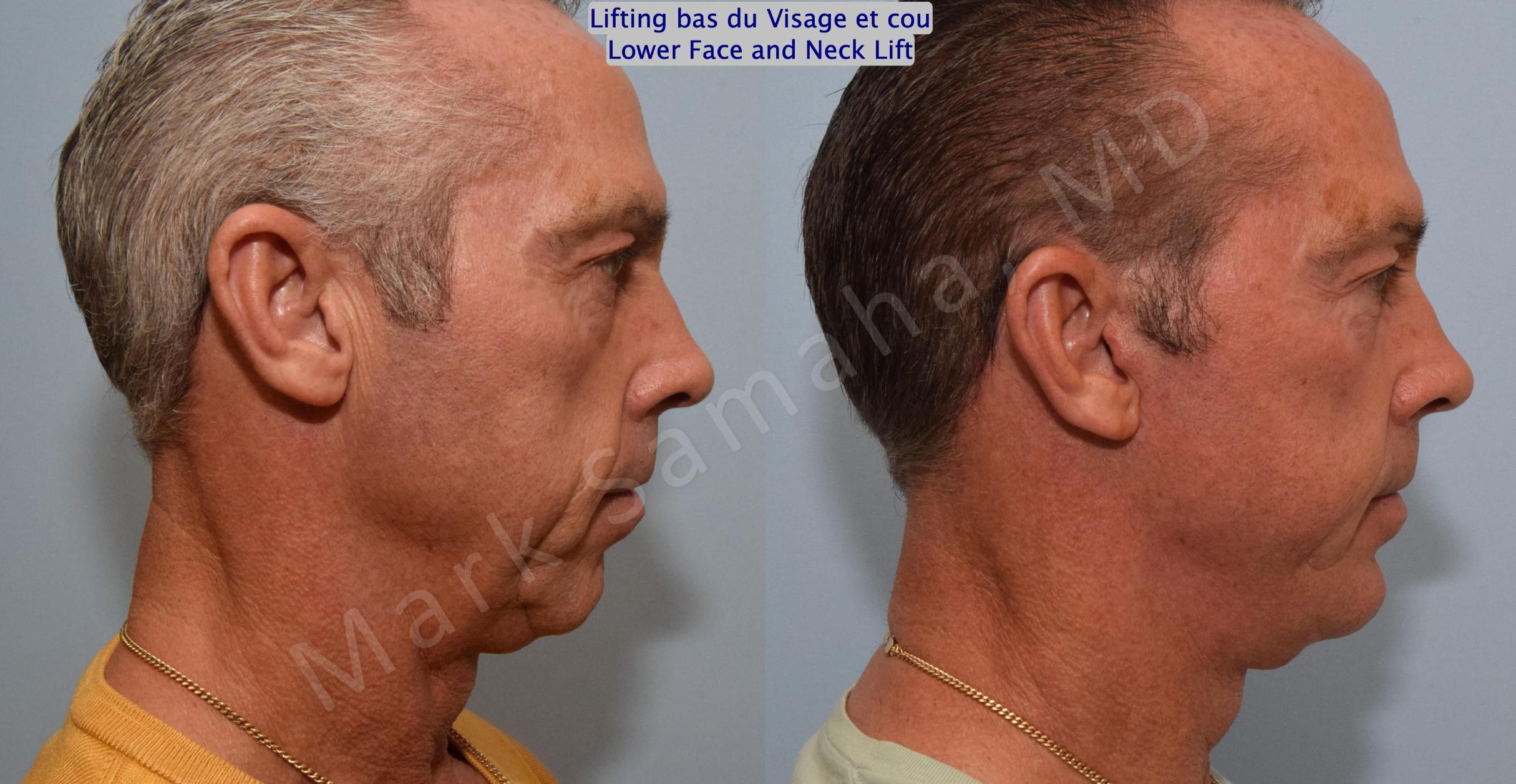 Before & After Facelift / Necklift - Lifting du visage / Cou Case 154 Right Side View in Mount Royal, QC
