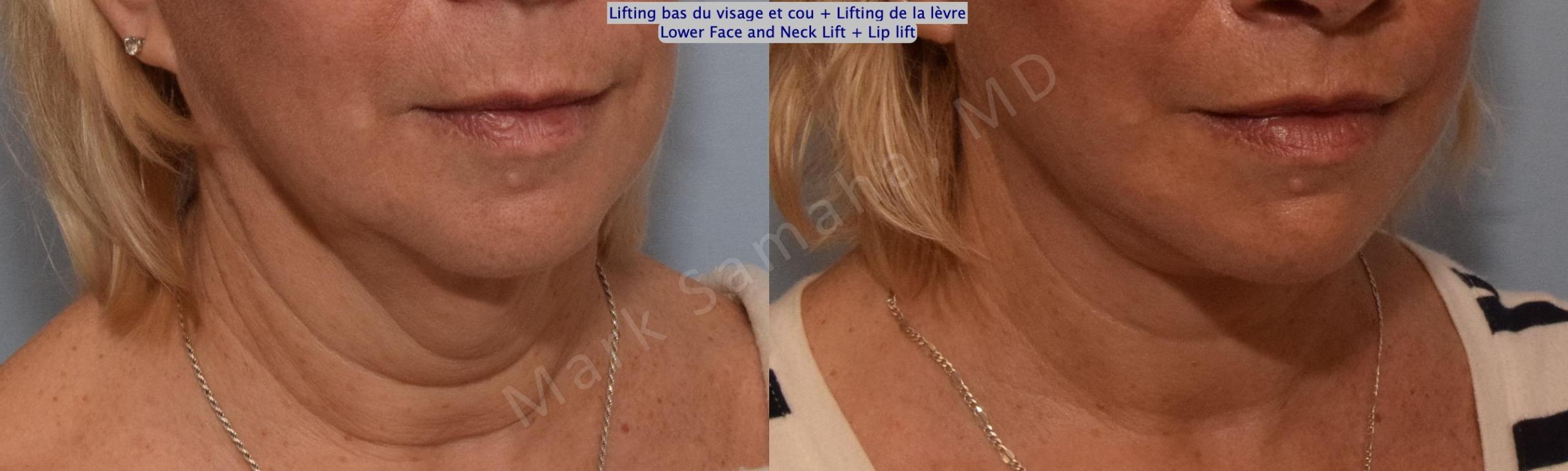 Before & After Lifting du visage / Cou - Facelift / Necklift Case 158 Right Oblique View in Mount Royal, QC