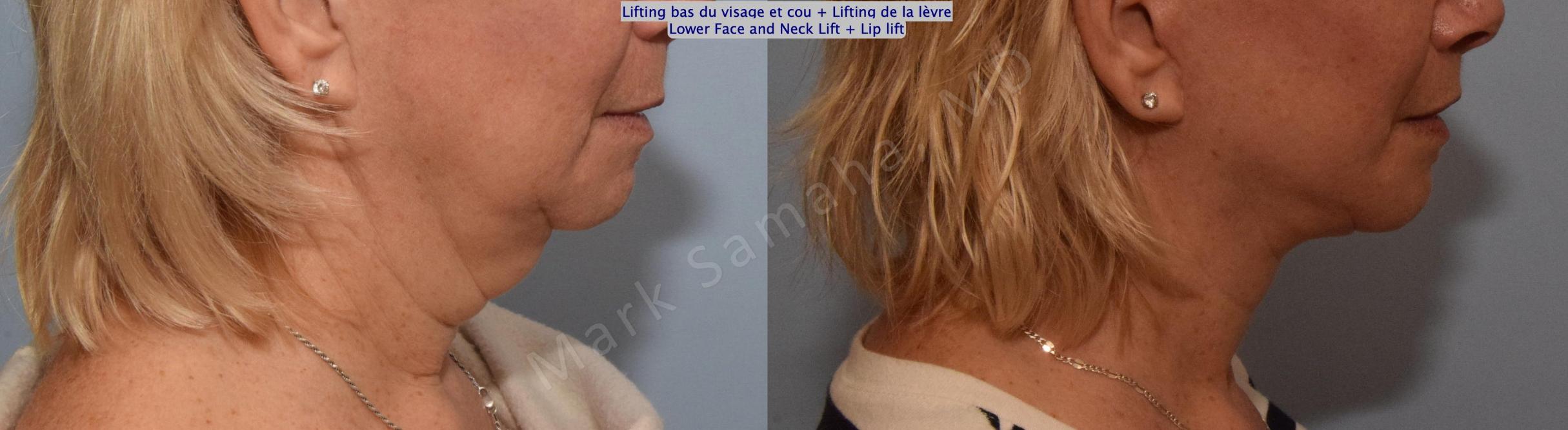 Before & After Lifting du visage / Cou - Facelift / Necklift Case 158 Right Side View in Mount Royal, QC