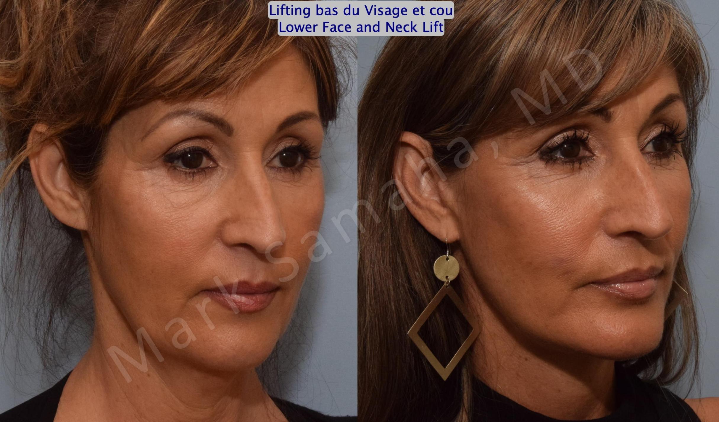 Before & After Facelift / Necklift - Lifting du visage / Cou Case 159 Right Oblique View in Mount Royal, QC