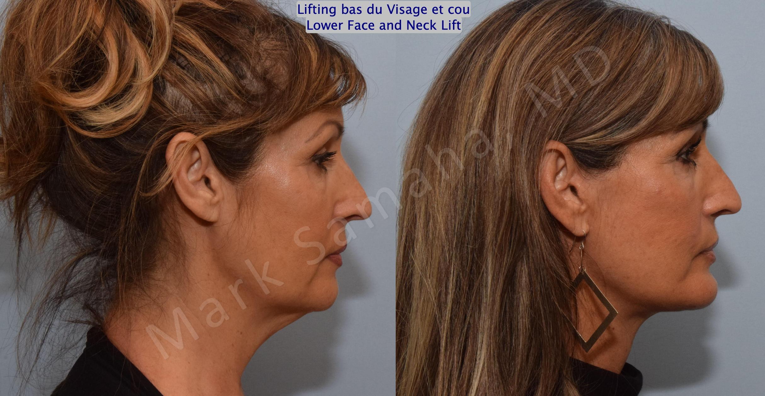 Before & After Facelift / Necklift - Lifting du visage / Cou Case 159 Right Side View in Mount Royal, QC