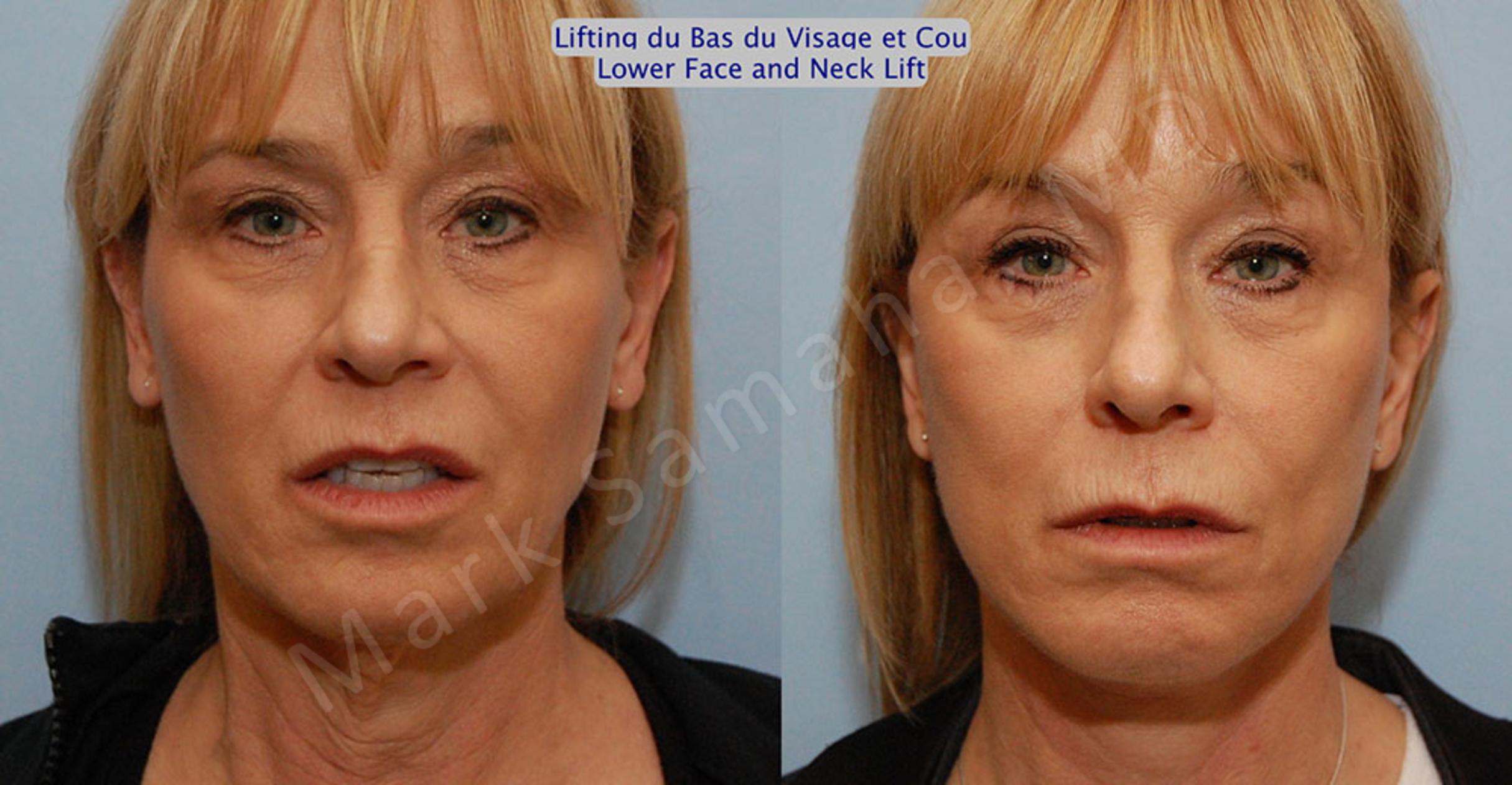 Before & After Facelift / Necklift - Lifting du visage / Cou Case 16 View #2 View in Mount Royal, QC