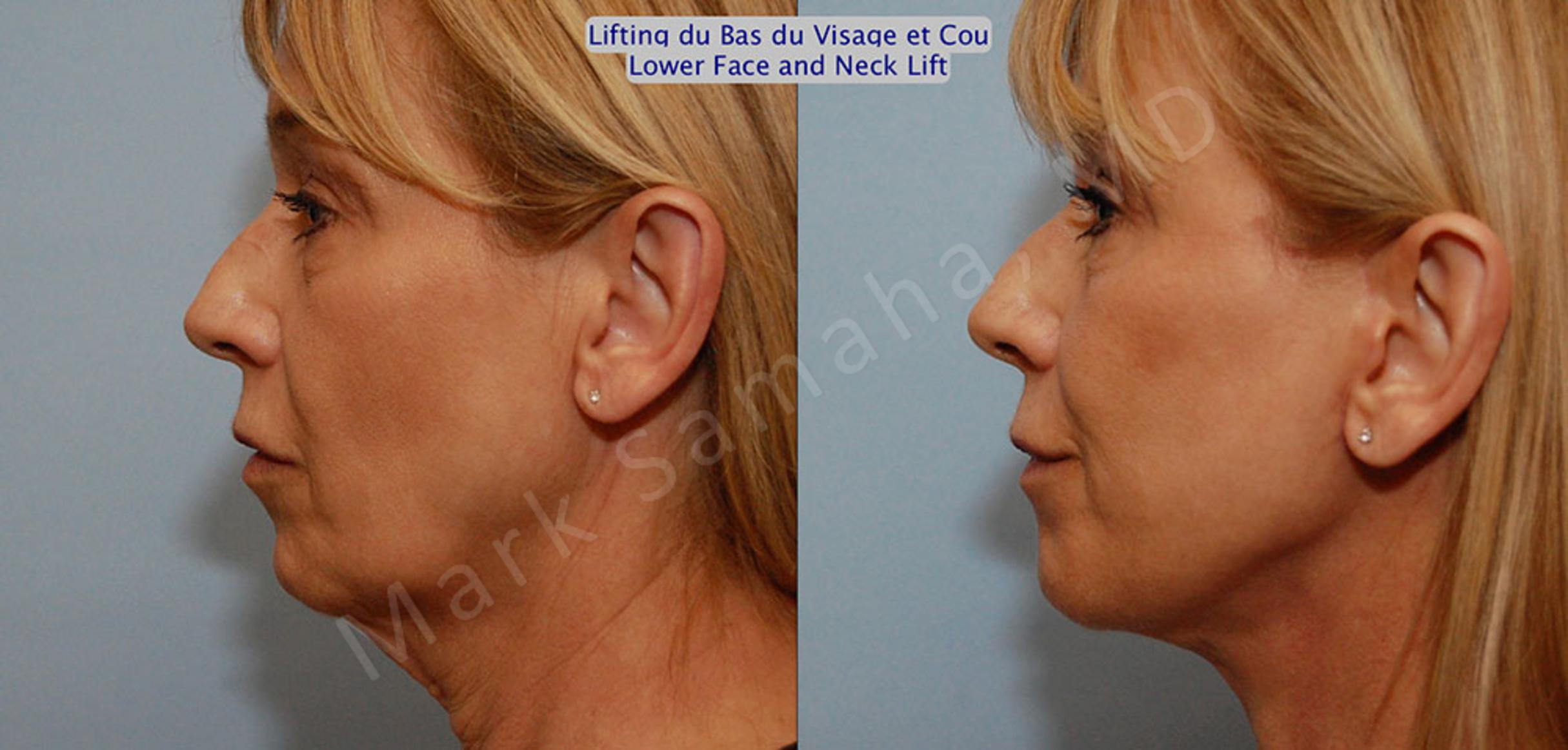 Before & After Lifting du visage / Cou - Facelift / Necklift Case 16 View #3 View in Mount Royal, QC