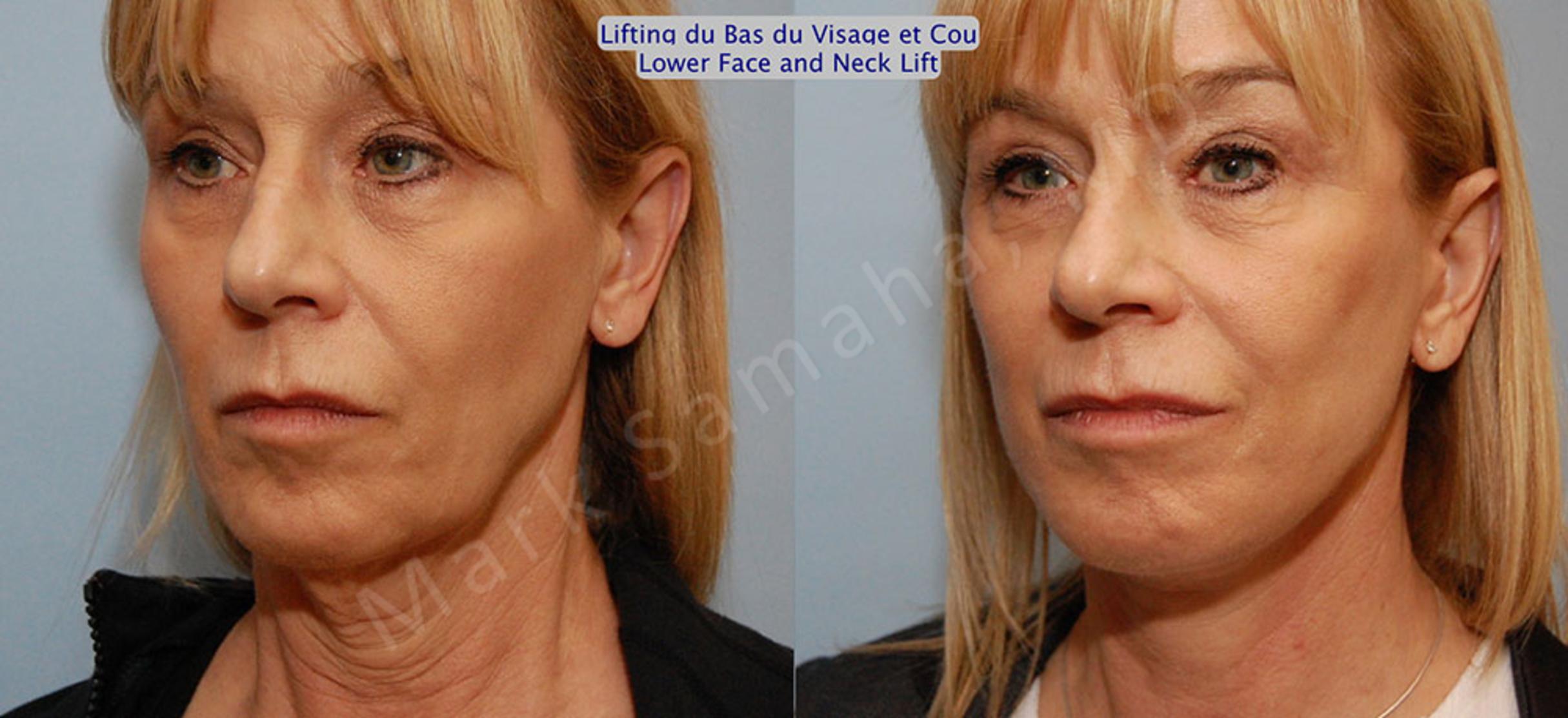 Before & After Lifting du visage / Cou - Facelift / Necklift Case 16 View #4 View in Mount Royal, QC