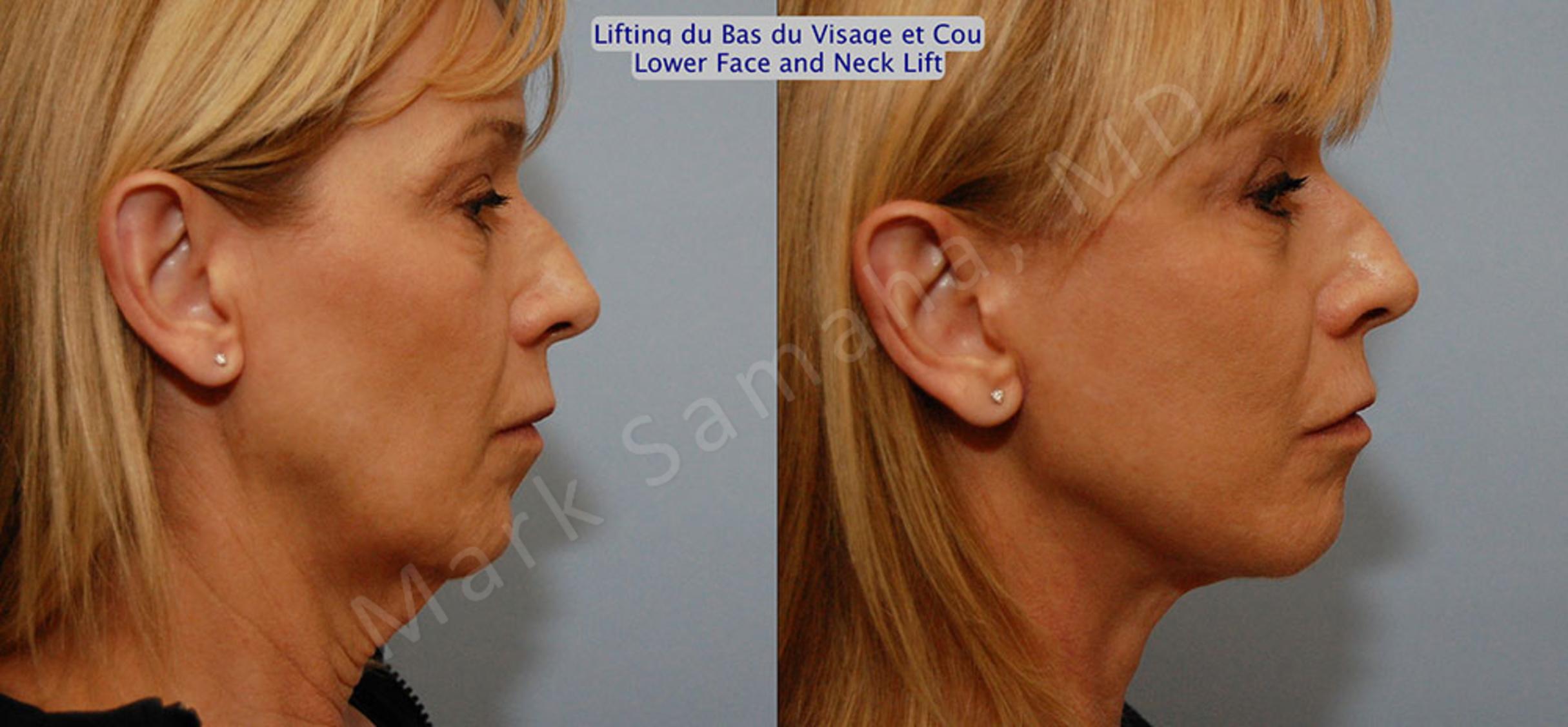 Before & After Lifting du visage / Cou - Facelift / Necklift Case 16 View #6 View in Mount Royal, QC