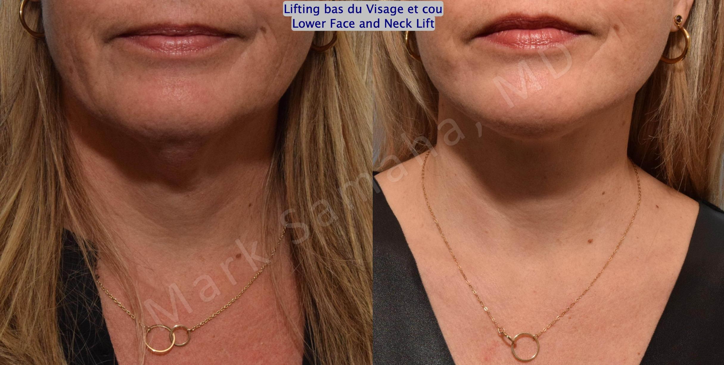 Before & After Facelift / Necklift - Lifting du visage / Cou Case 160 Frontal Neck / Cou View in Mount Royal, QC