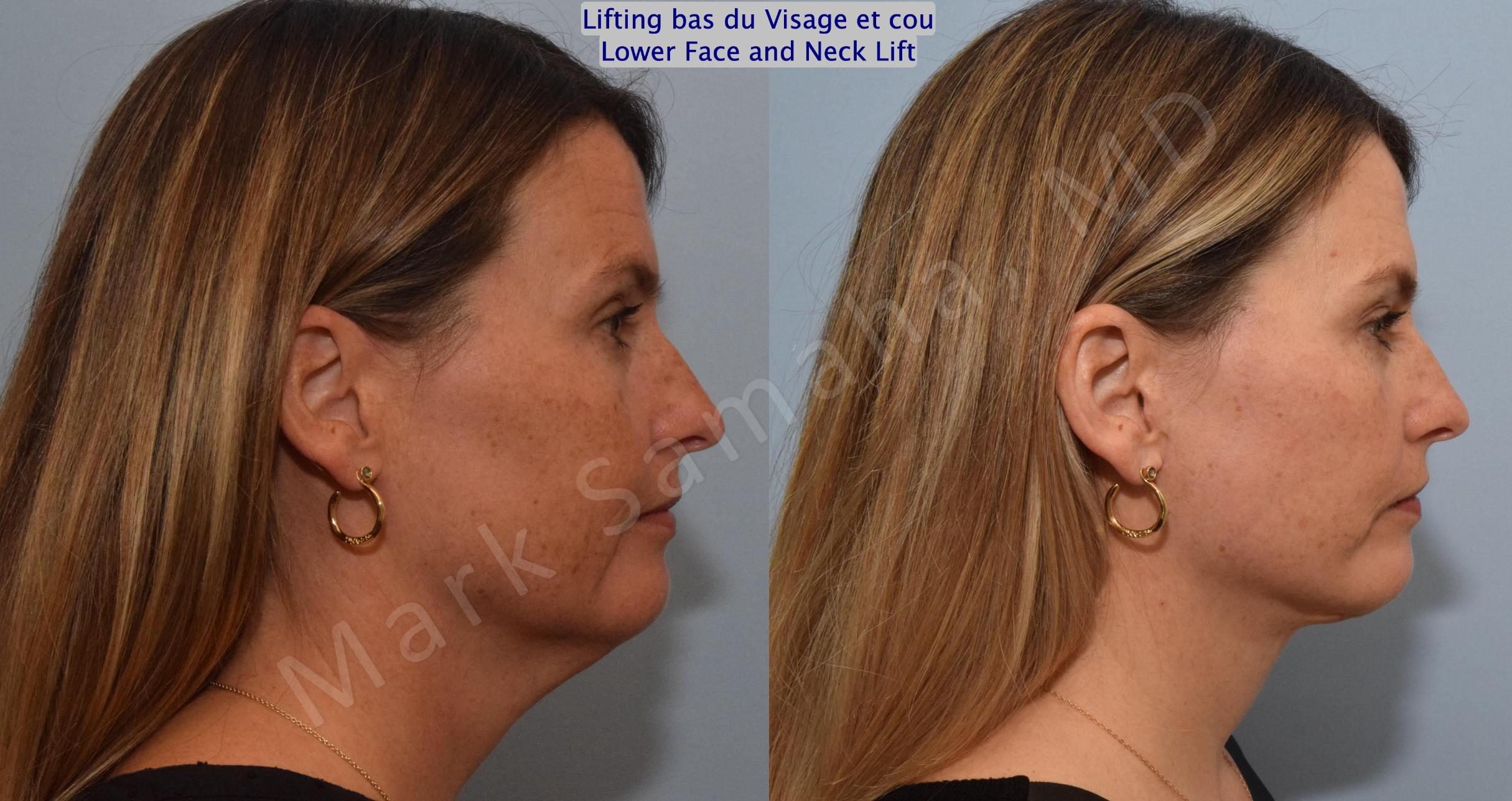 Before & After Facelift / Necklift - Lifting du visage / Cou Case 160 Right Side View in Mount Royal, QC