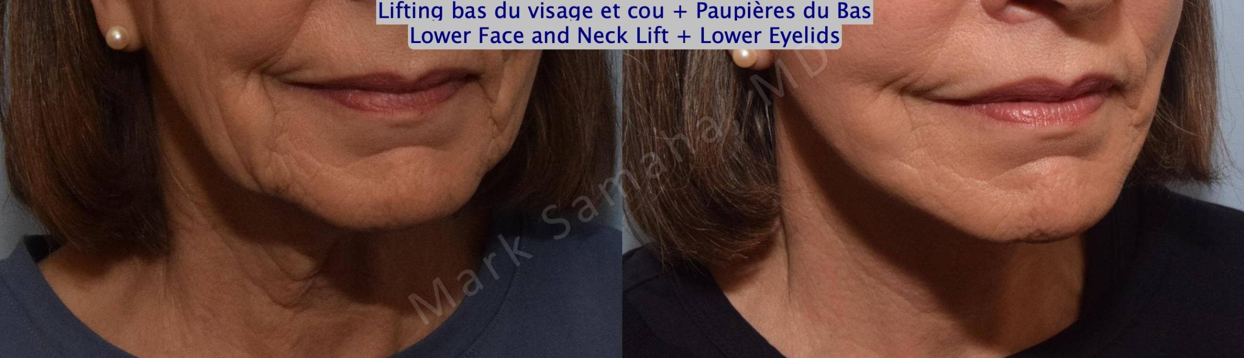 Lifting Du Visage Cou Facelift Necklift Avant And Après Photos