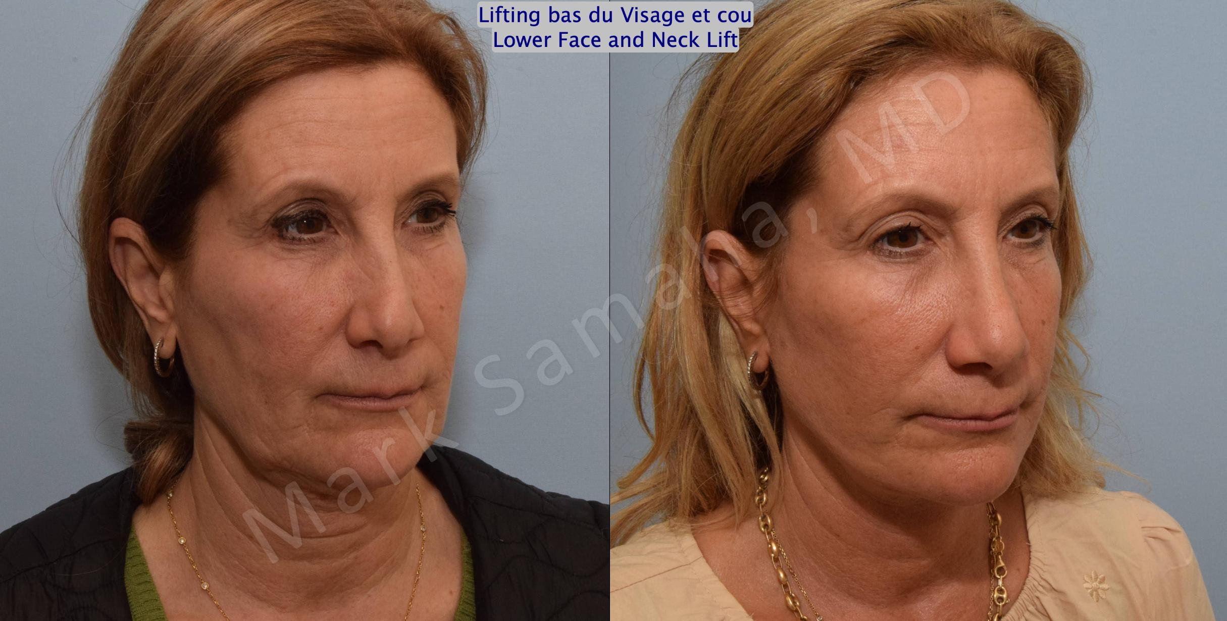 Before & After Facelift / Necklift - Lifting du visage / Cou Case 163 Right Oblique View in Mount Royal, QC
