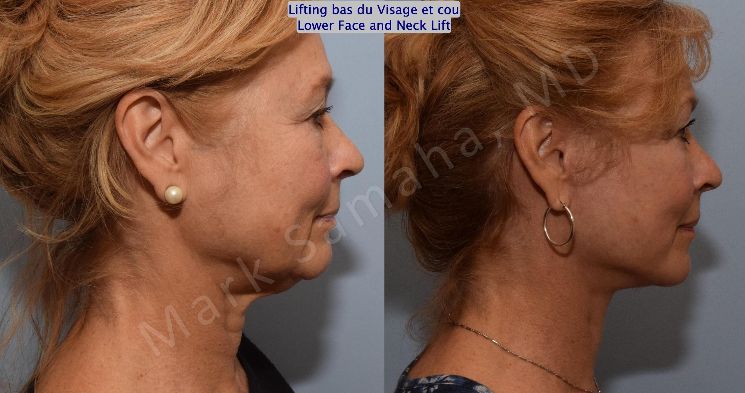 Before & After Lifting du visage / Cou - Facelift / Necklift Case 164 Right Side View in Mount Royal, QC