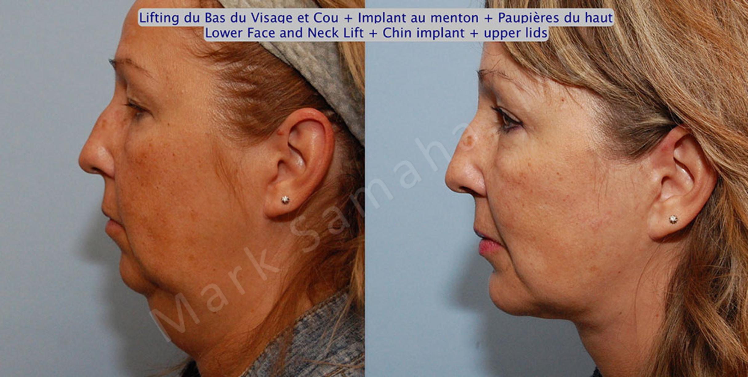 Before & After Chin Augmentation / Augmentation du menton Case 17 View #1 View in Mount Royal, QC