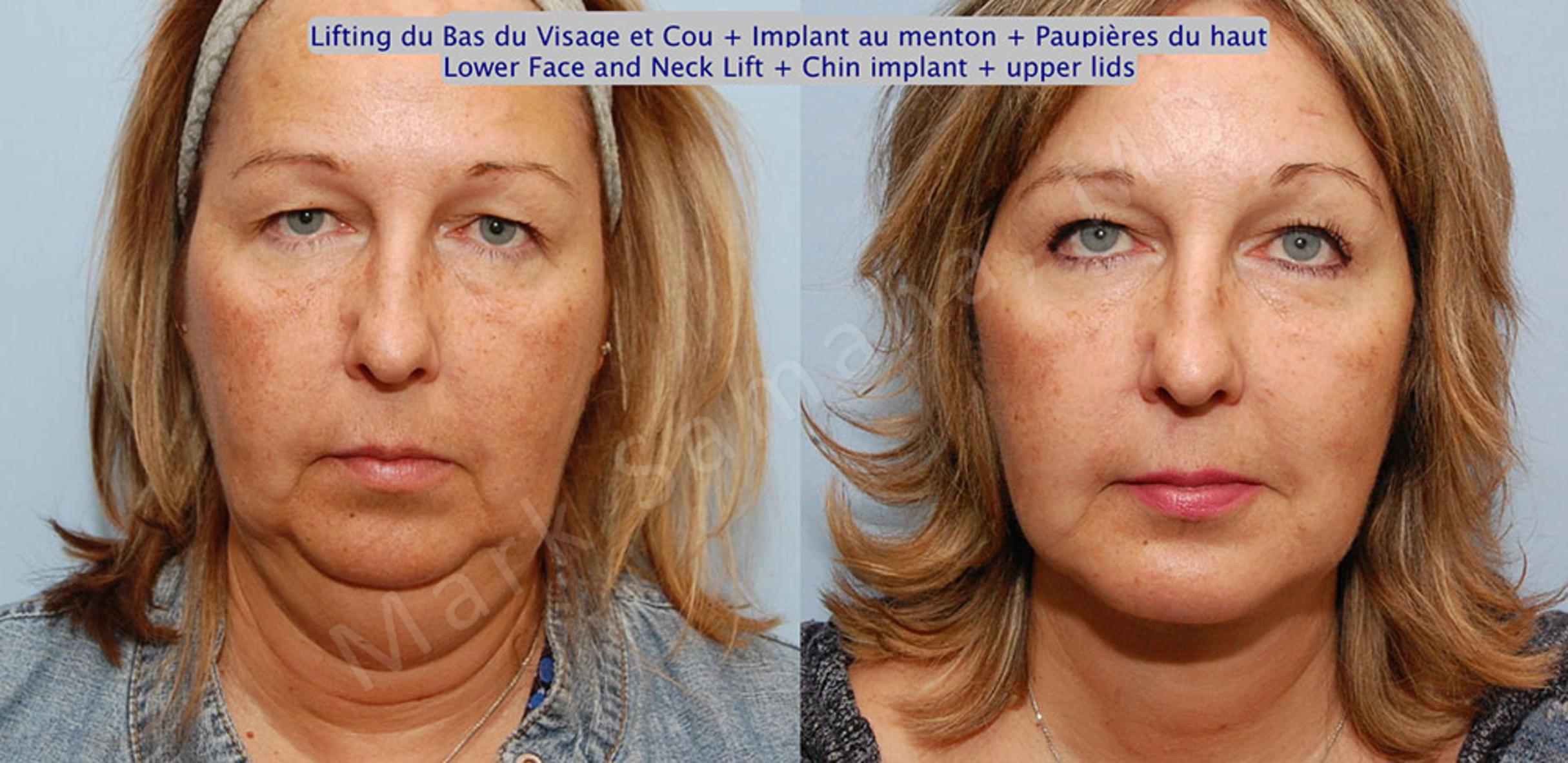 Before & After Chin Augmentation / Augmentation du menton Case 17 View #2 View in Mount Royal, QC