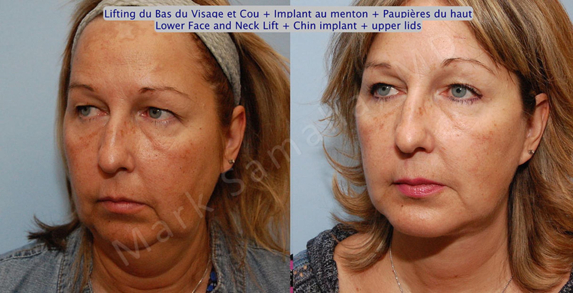 Before & After Facelift / Necklift - Lifting du visage / Cou Case 17 View #3 View in Mount Royal, QC