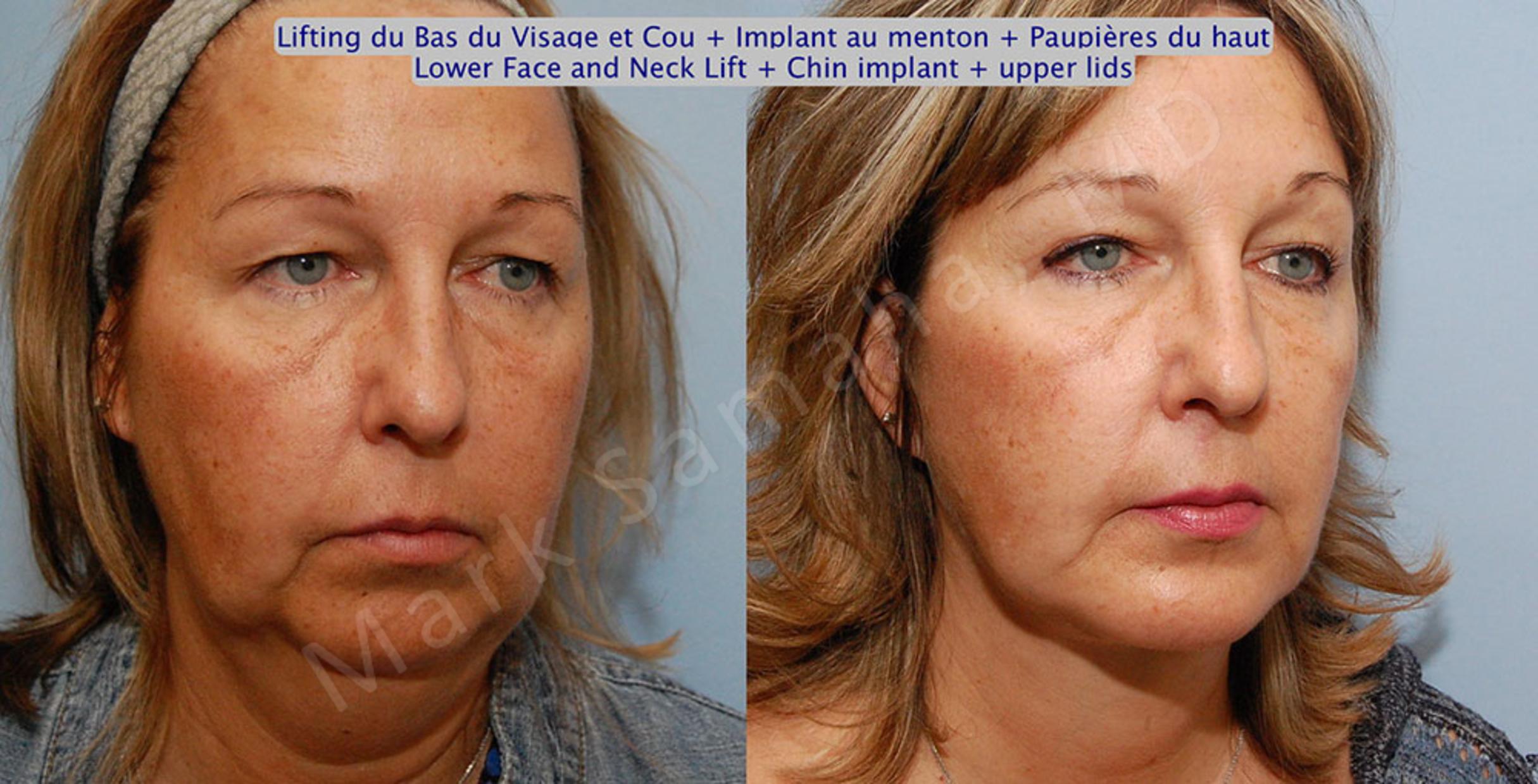 Before & After Facelift / Necklift - Lifting du visage / Cou Case 17 View #4 View in Mount Royal, QC