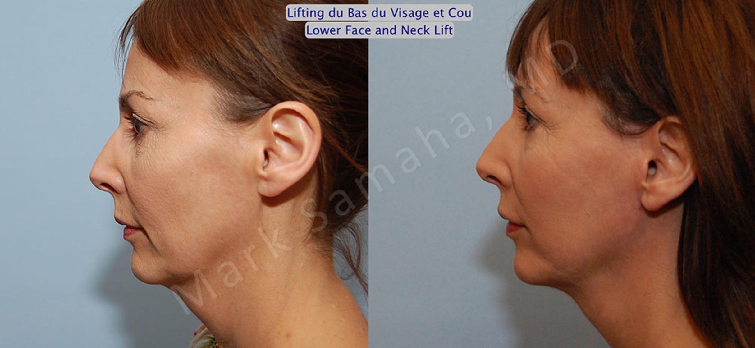 Before & After Facelift / Necklift - Lifting du visage / Cou Case 18 View #2 View in Mount Royal, QC