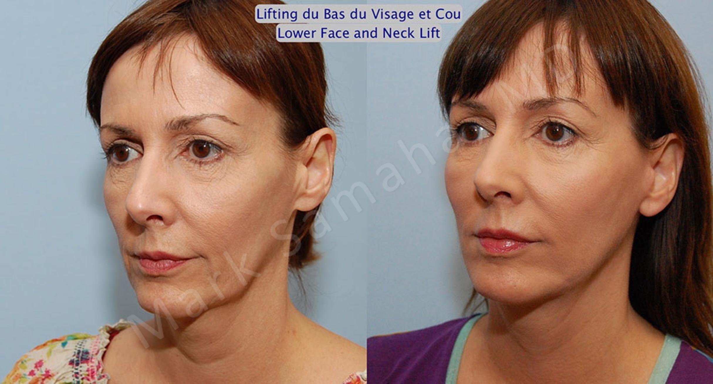 Before & After Lifting du visage / Cou - Facelift / Necklift Case 18 View #3 View in Mount Royal, QC