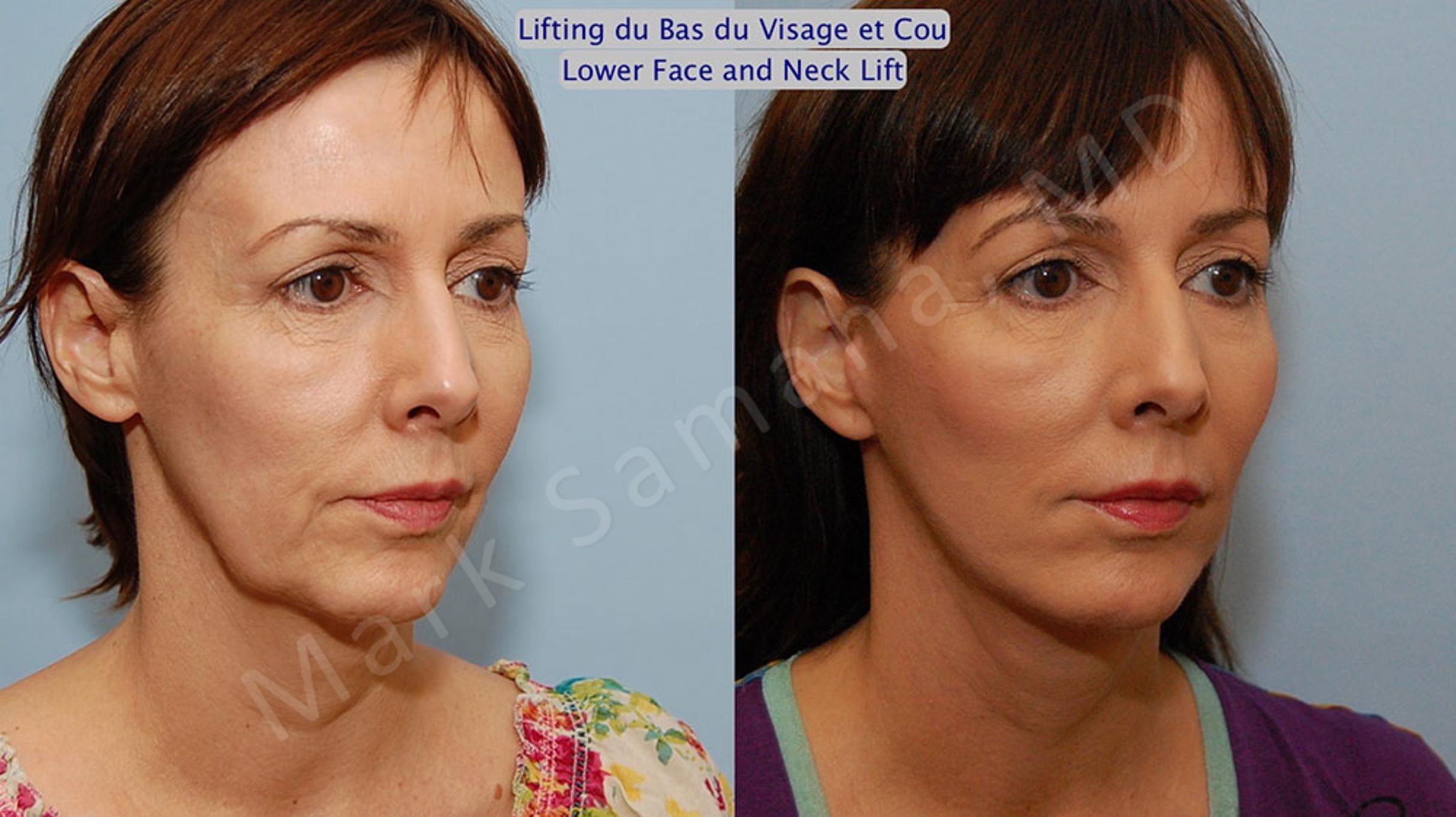 Before & After Facelift / Necklift - Lifting du visage / Cou Case 18 View #4 View in Mount Royal, QC