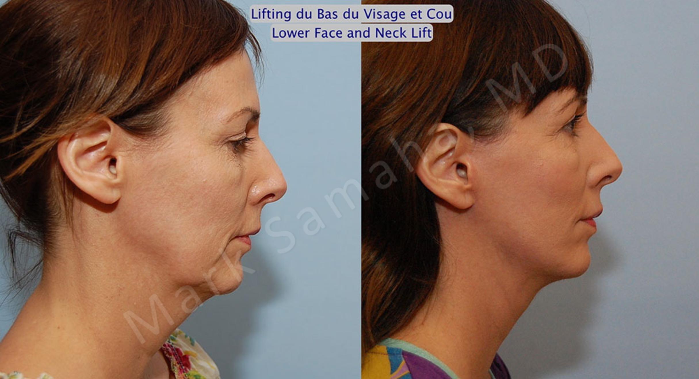 Before & After Facelift / Necklift - Lifting du visage / Cou Case 18 View #5 View in Mount Royal, QC