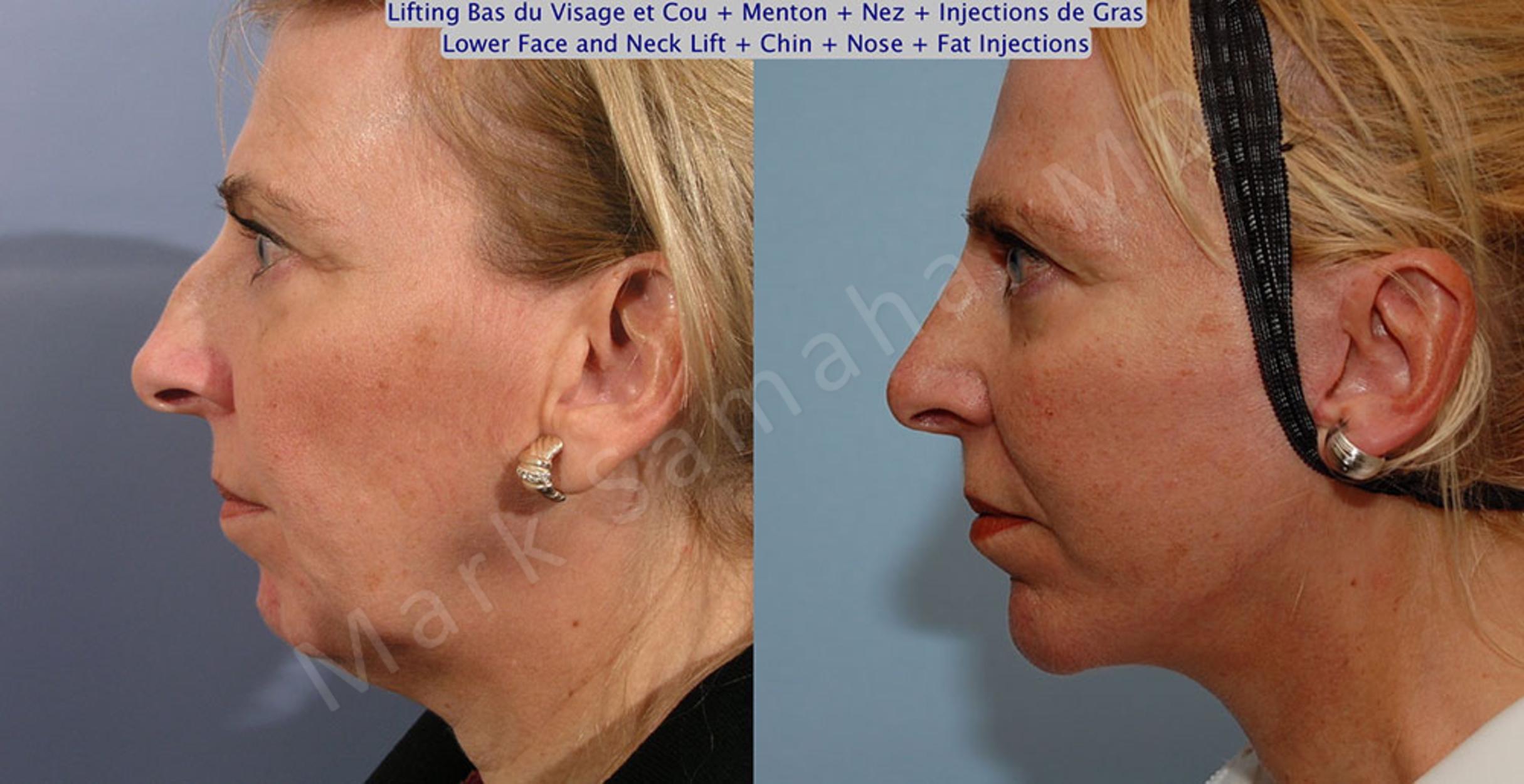 Before & After Facelift / Necklift - Lifting du visage / Cou Case 19 View #1 View in Mount Royal, QC