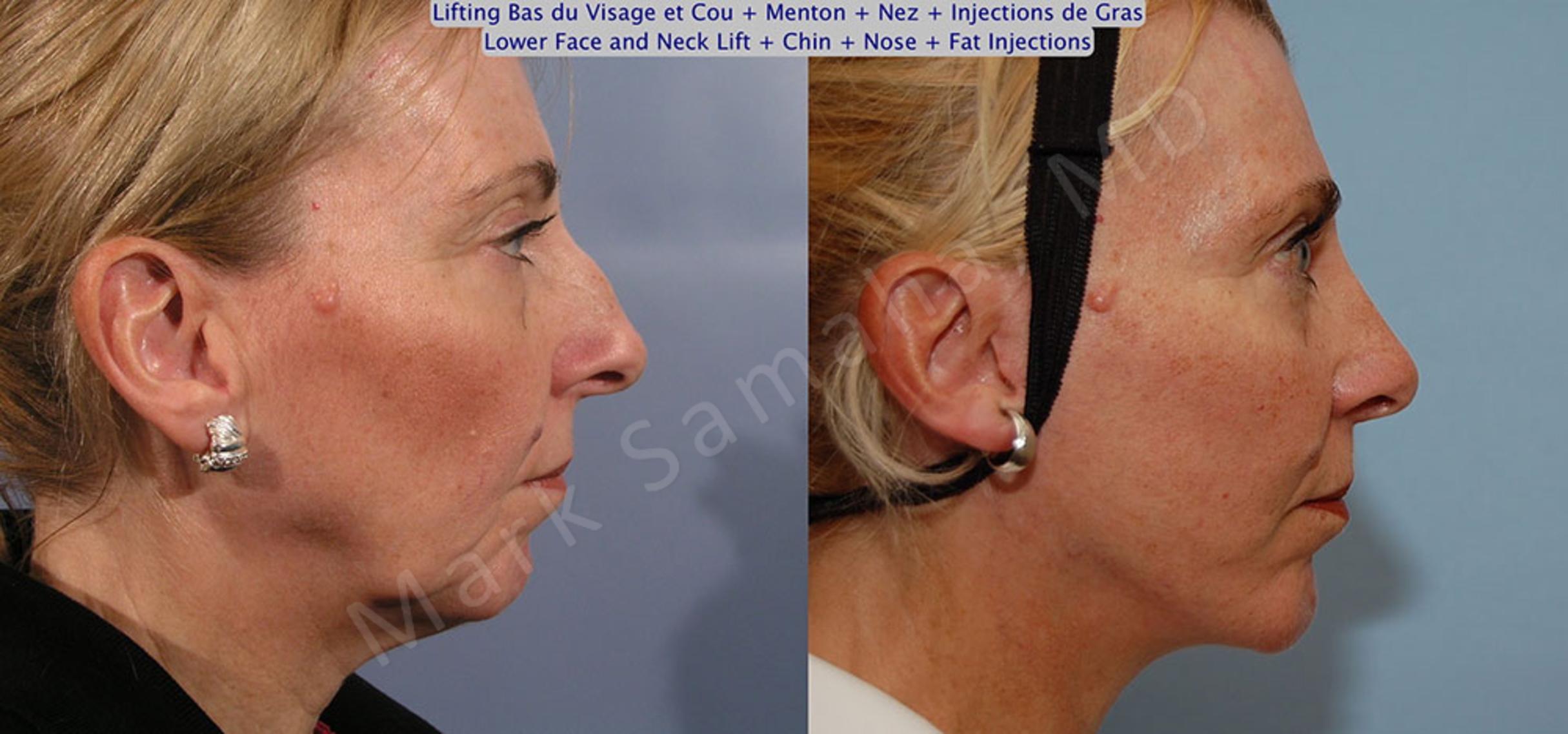 Before & After Lifting du visage / Cou - Facelift / Necklift Case 19 View #5 View in Mount Royal, QC