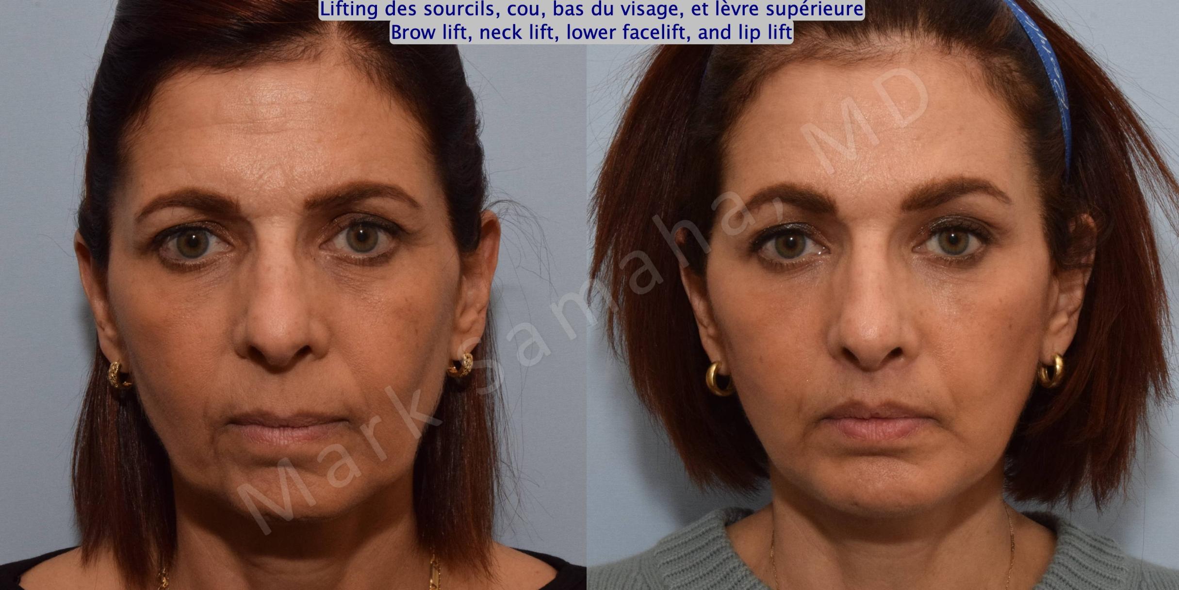 Before & After Lifting du Sourcil / Brow lift Case 195 Front View in Mount Royal, QC