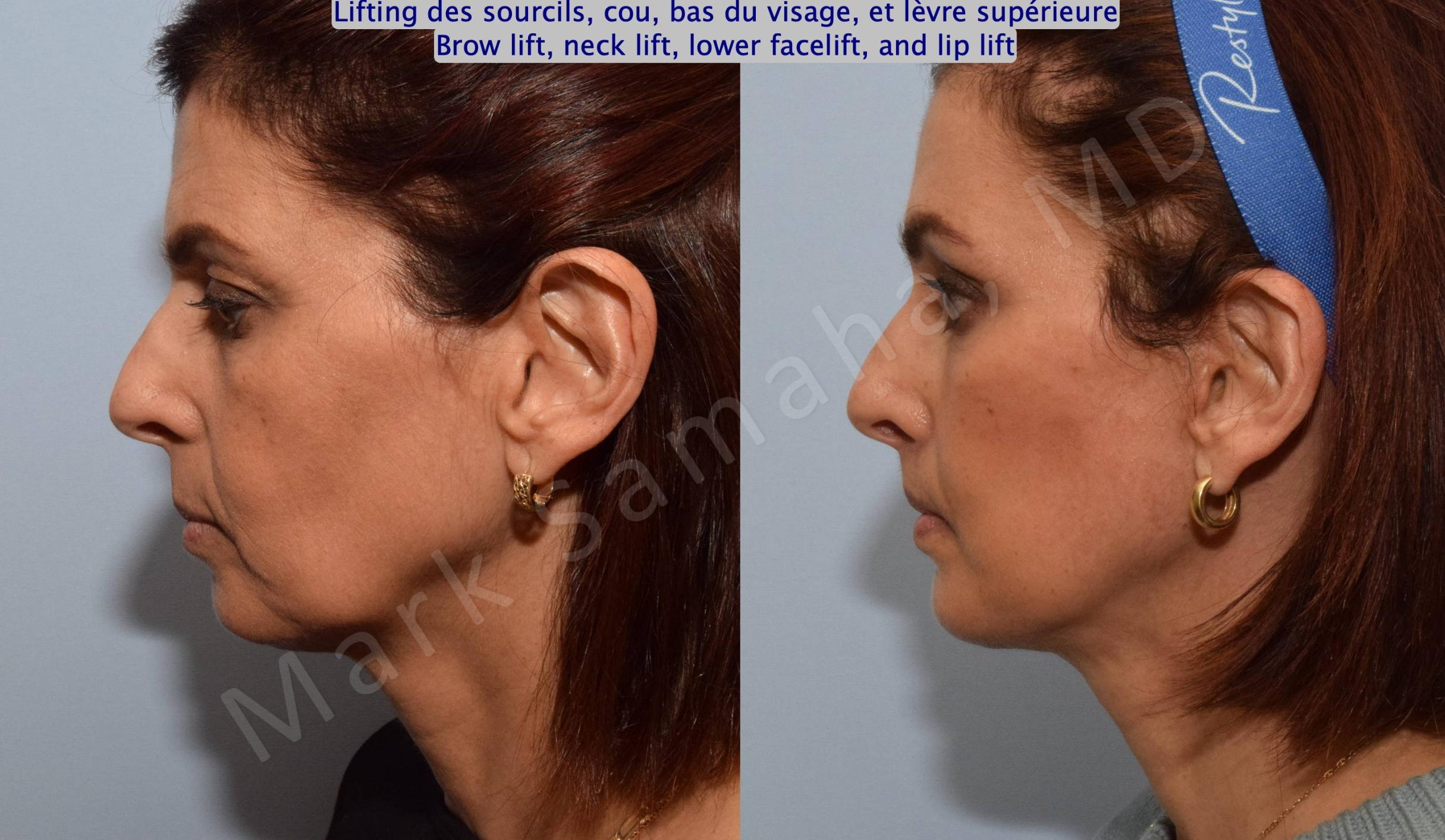 Before & After Lifting du Sourcil / Brow lift Case 195 Left Side View in Mount Royal, QC