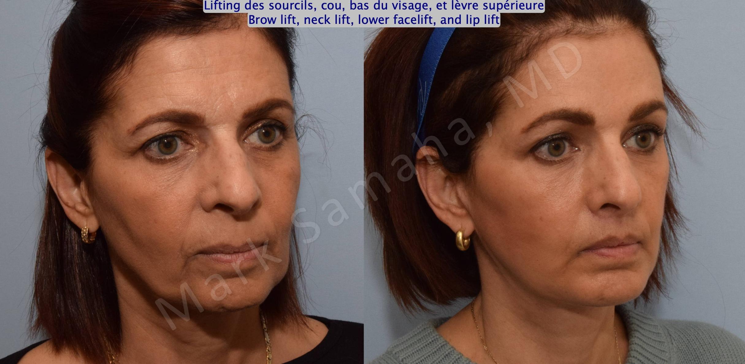 Before & After Facelift / Necklift - Lifting du visage / Cou Case 195 Right Oblique View in Mount Royal, QC