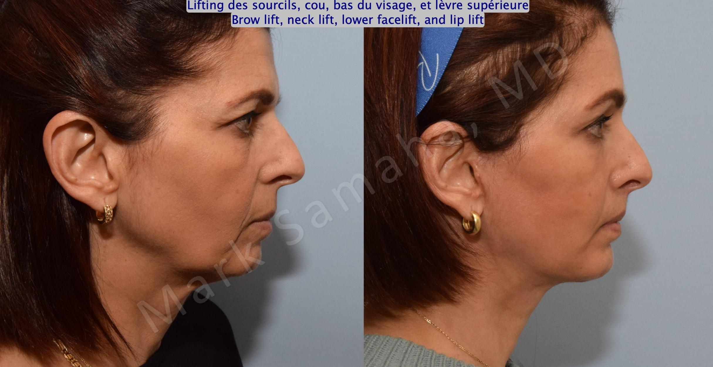 Before & After Lifting du visage / Cou - Facelift / Necklift Case 195 Right Side View in Mount Royal, QC