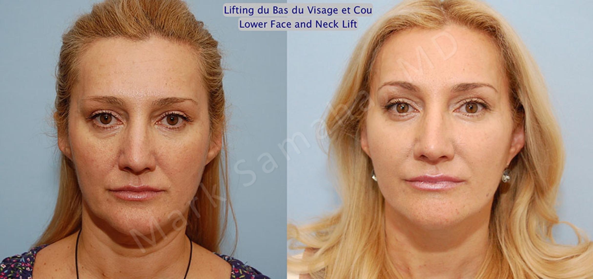 Before & After Lifting du visage / Cou - Facelift / Necklift Case 20 View #1 View in Mount Royal, QC