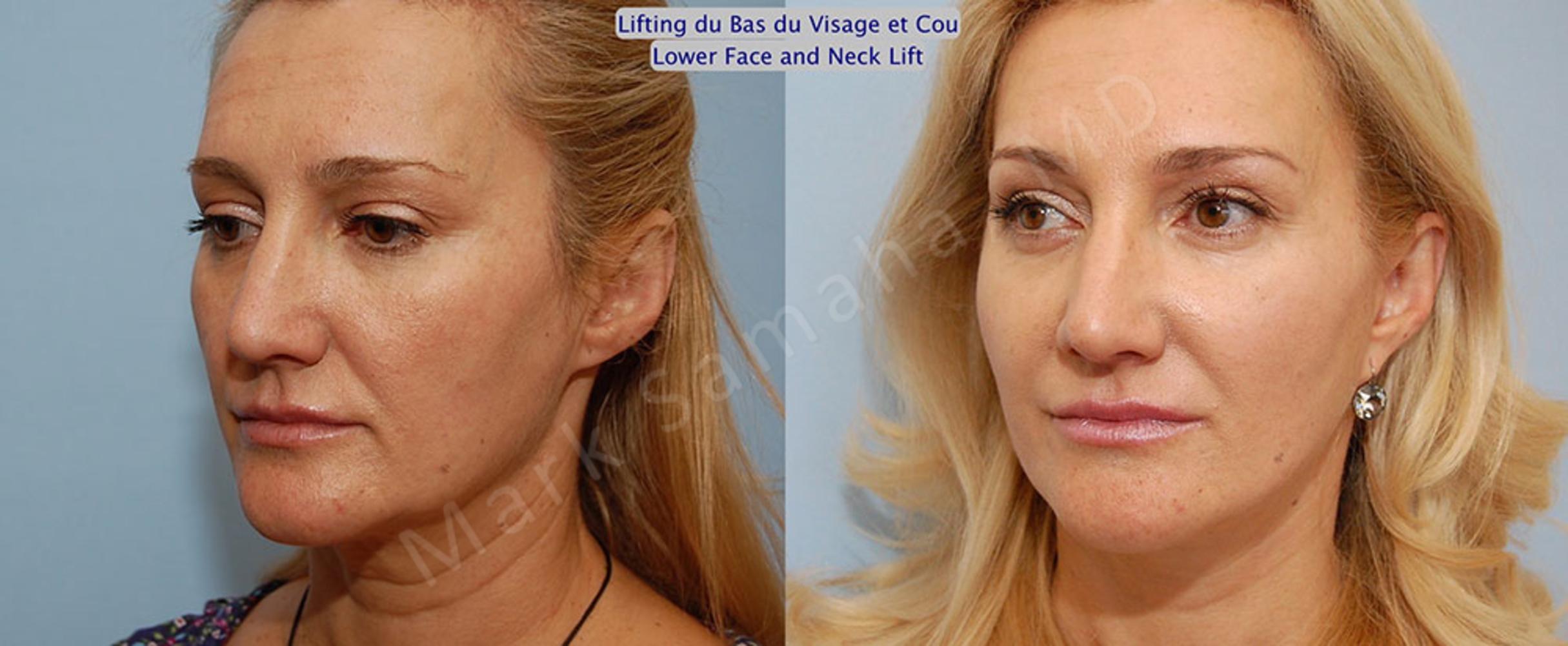 Before & After Facelift / Necklift - Lifting du visage / Cou Case 20 View #3 View in Mount Royal, QC