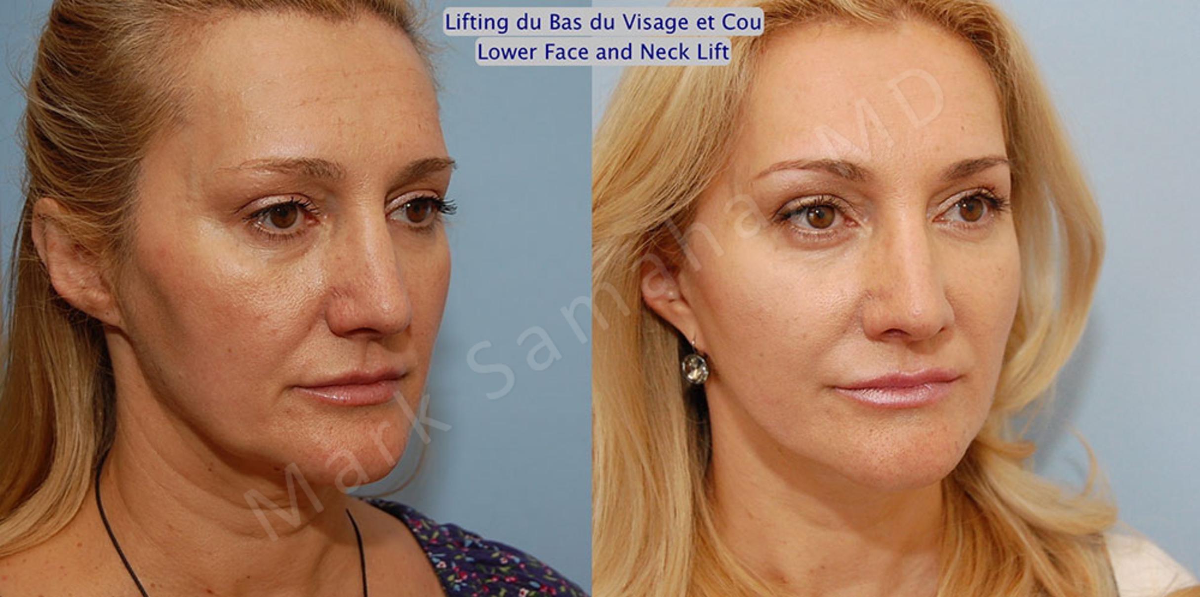 Before & After Facelift / Necklift - Lifting du visage / Cou Case 20 View #4 View in Mount Royal, QC