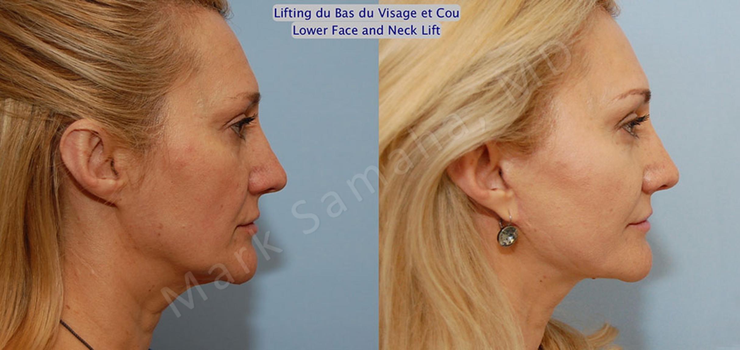 Before & After Facelift / Necklift - Lifting du visage / Cou Case 20 View #5 View in Mount Royal, QC