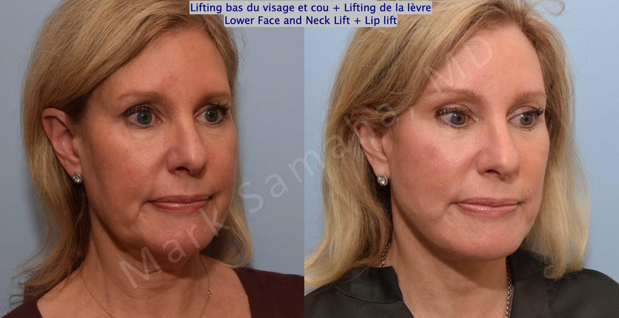 Before & After Facelift / Necklift - Lifting du visage / Cou Case 202 Right Oblique View in Mount Royal, QC