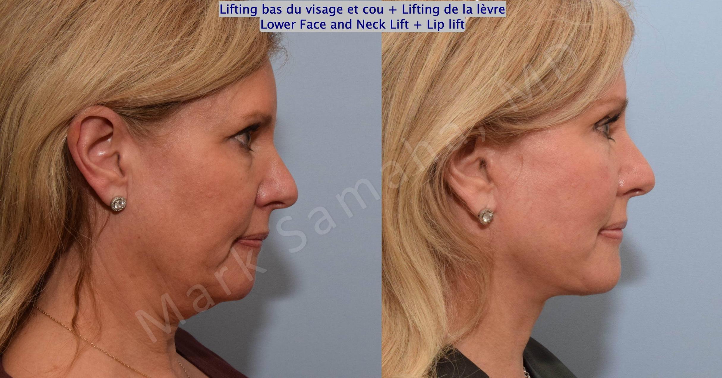 Before & After Lifting du visage / Cou - Facelift / Necklift Case 202 Right Side View in Mount Royal, QC