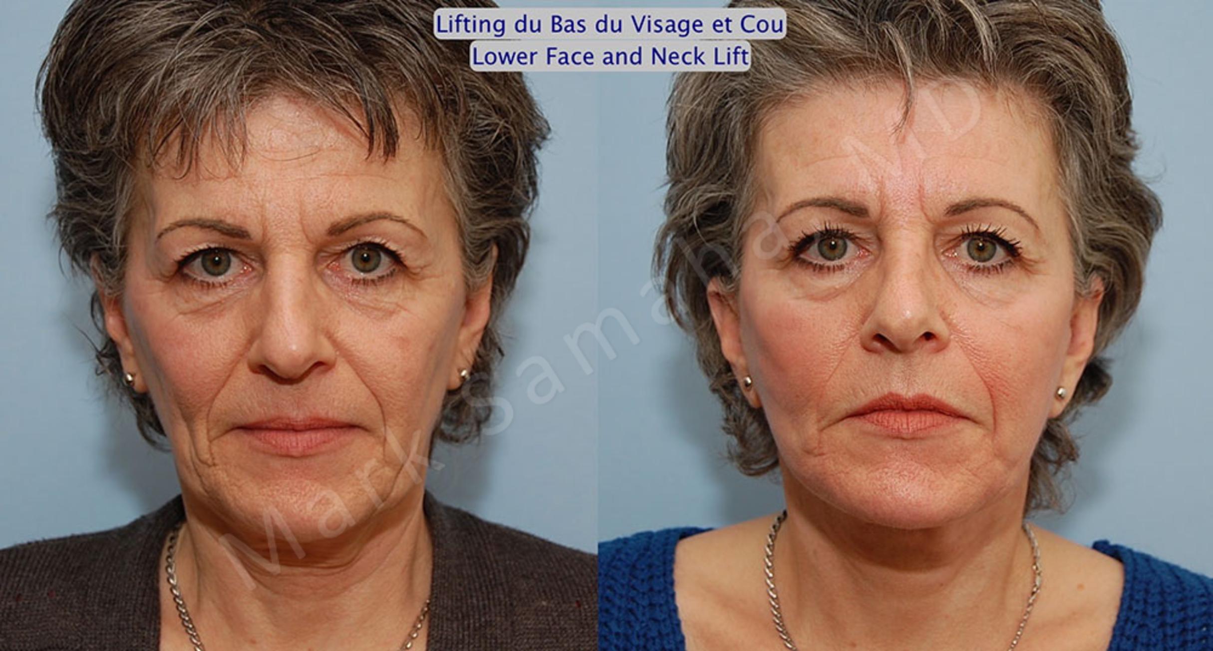 Before & After Facelift / Necklift - Lifting du visage / Cou Case 21 View #1 View in Mount Royal, QC
