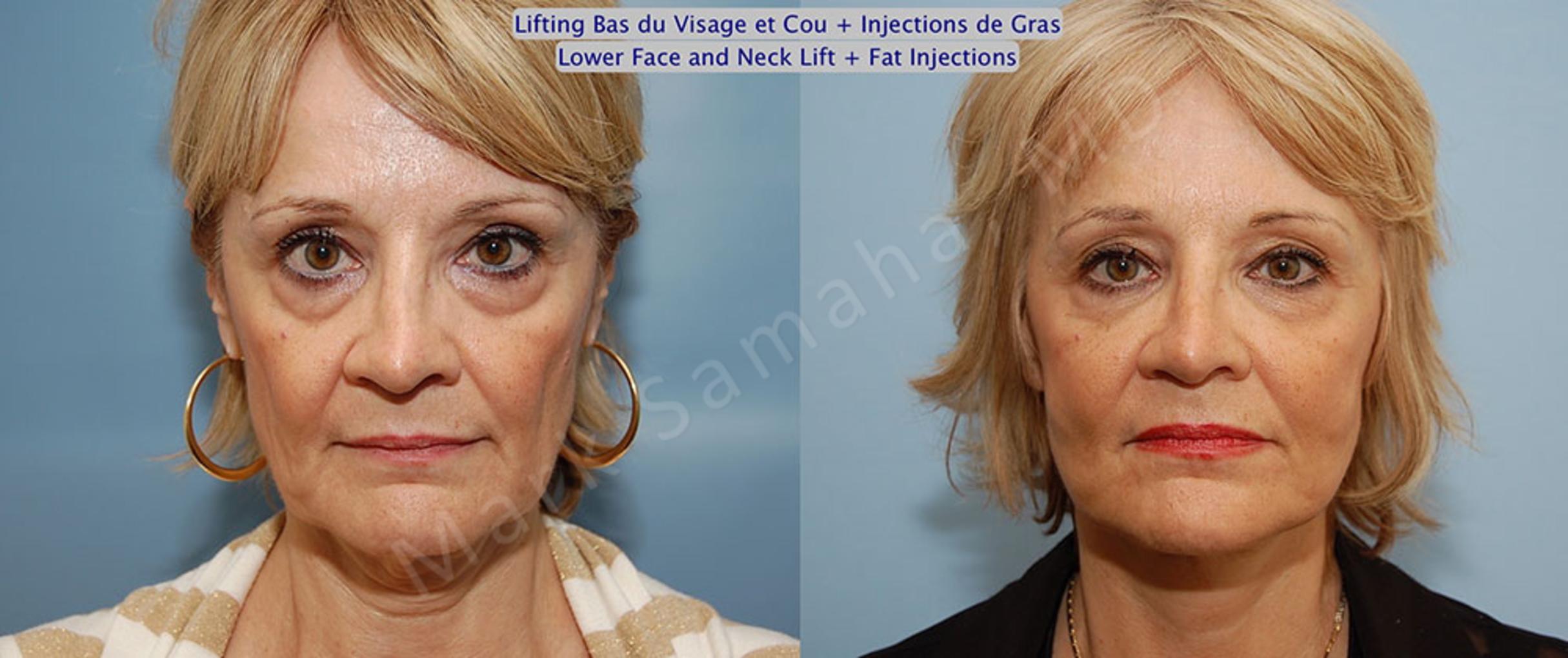Before & After Facelift / Necklift - Lifting du visage / Cou Case 22 View #1 View in Mount Royal, QC