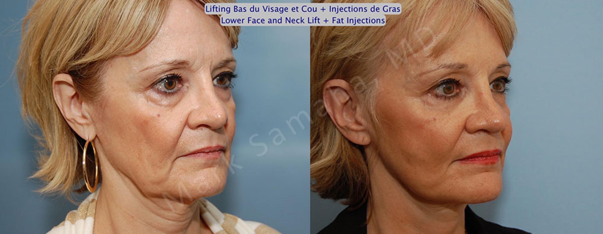 Before & After Lifting du visage / Cou - Facelift / Necklift Case 22 View #4 View in Mount Royal, QC