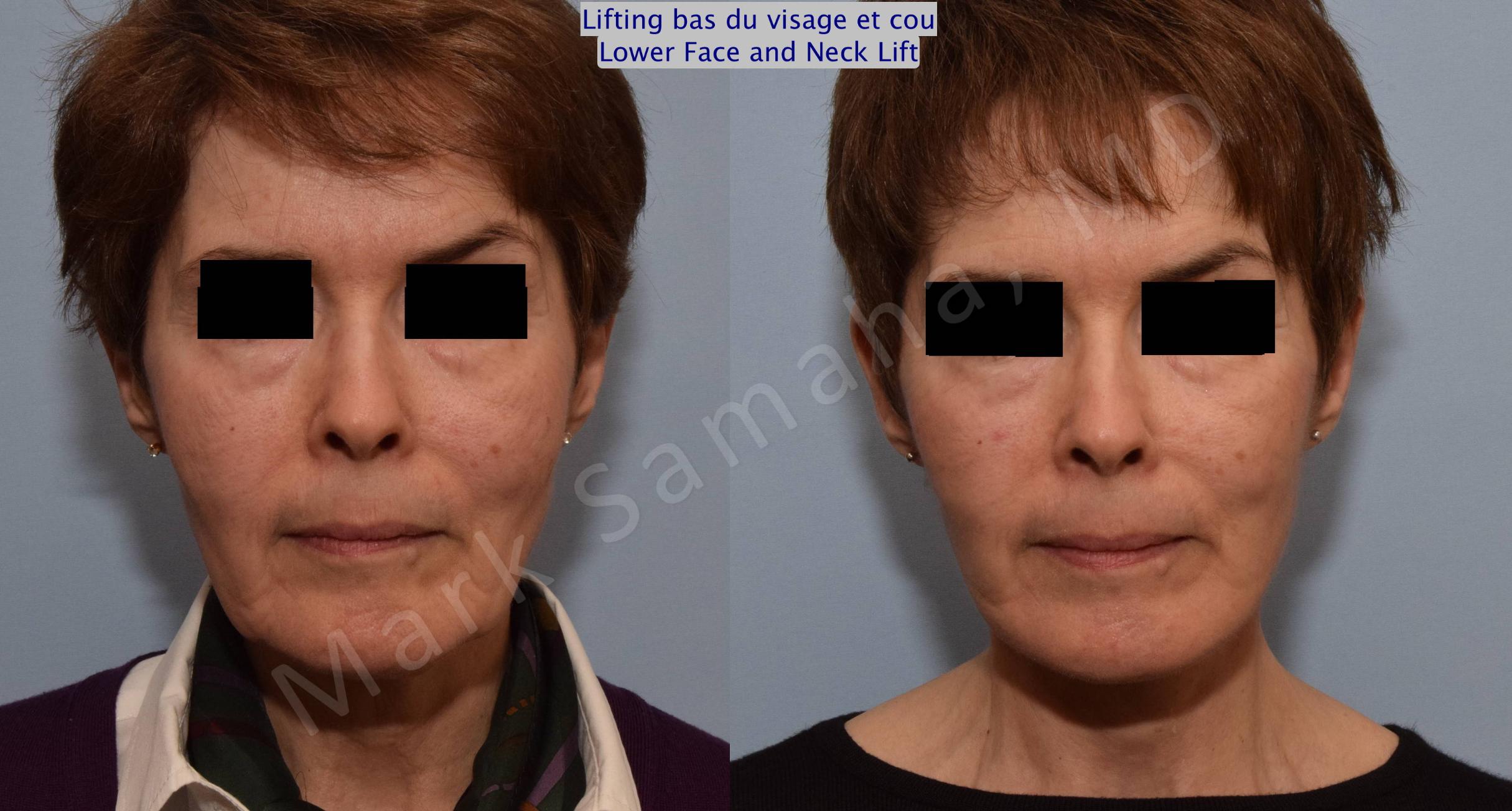 Before & After Lifting du visage / Cou - Facelift / Necklift Case 66 View #1 View in Mount Royal, QC