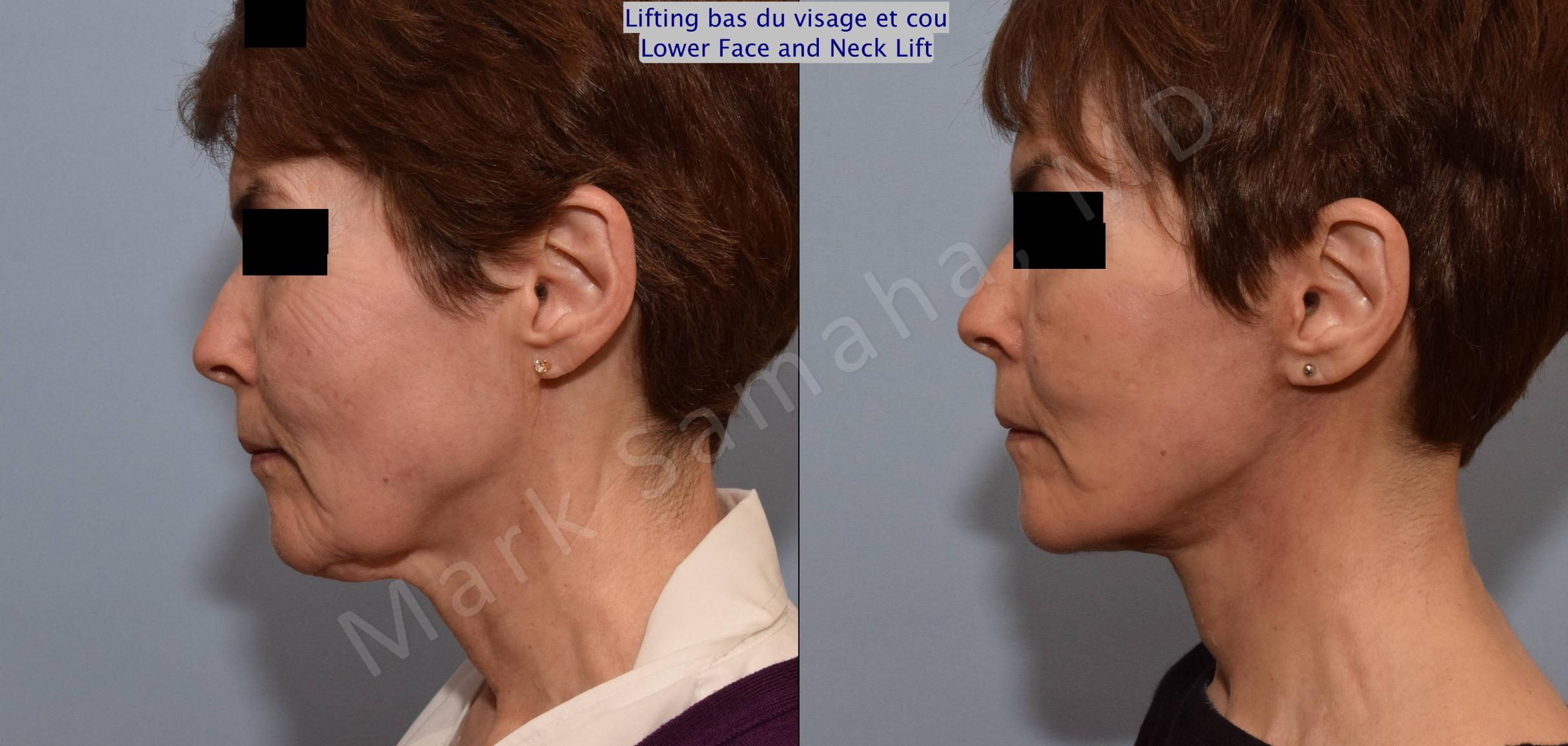 Before & After Facelift / Necklift - Lifting du visage / Cou Case 66 View #2 View in Mount Royal, QC