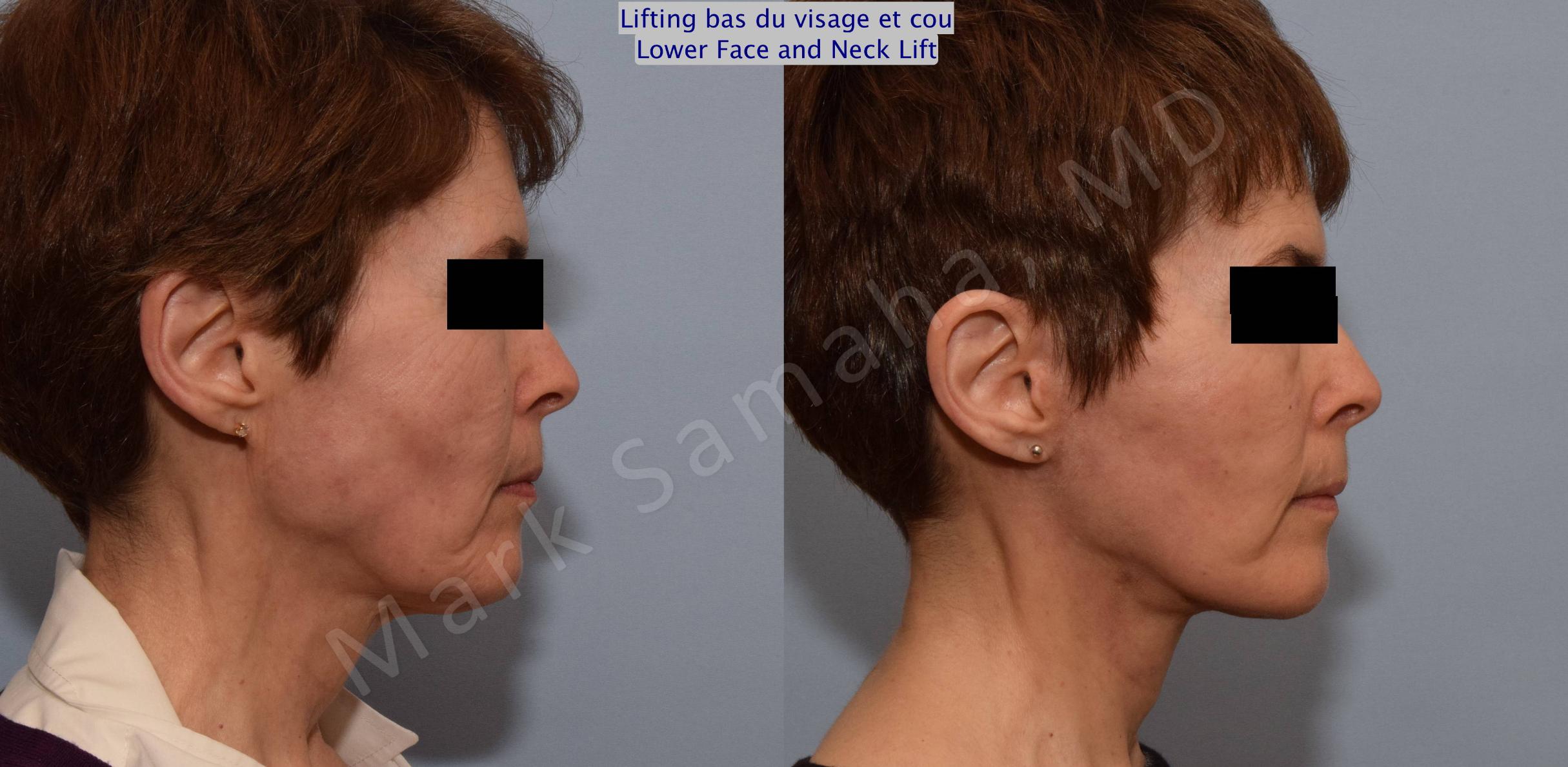 Before & After Lifting du visage / Cou - Facelift / Necklift Case 66 View #3 View in Mount Royal, QC