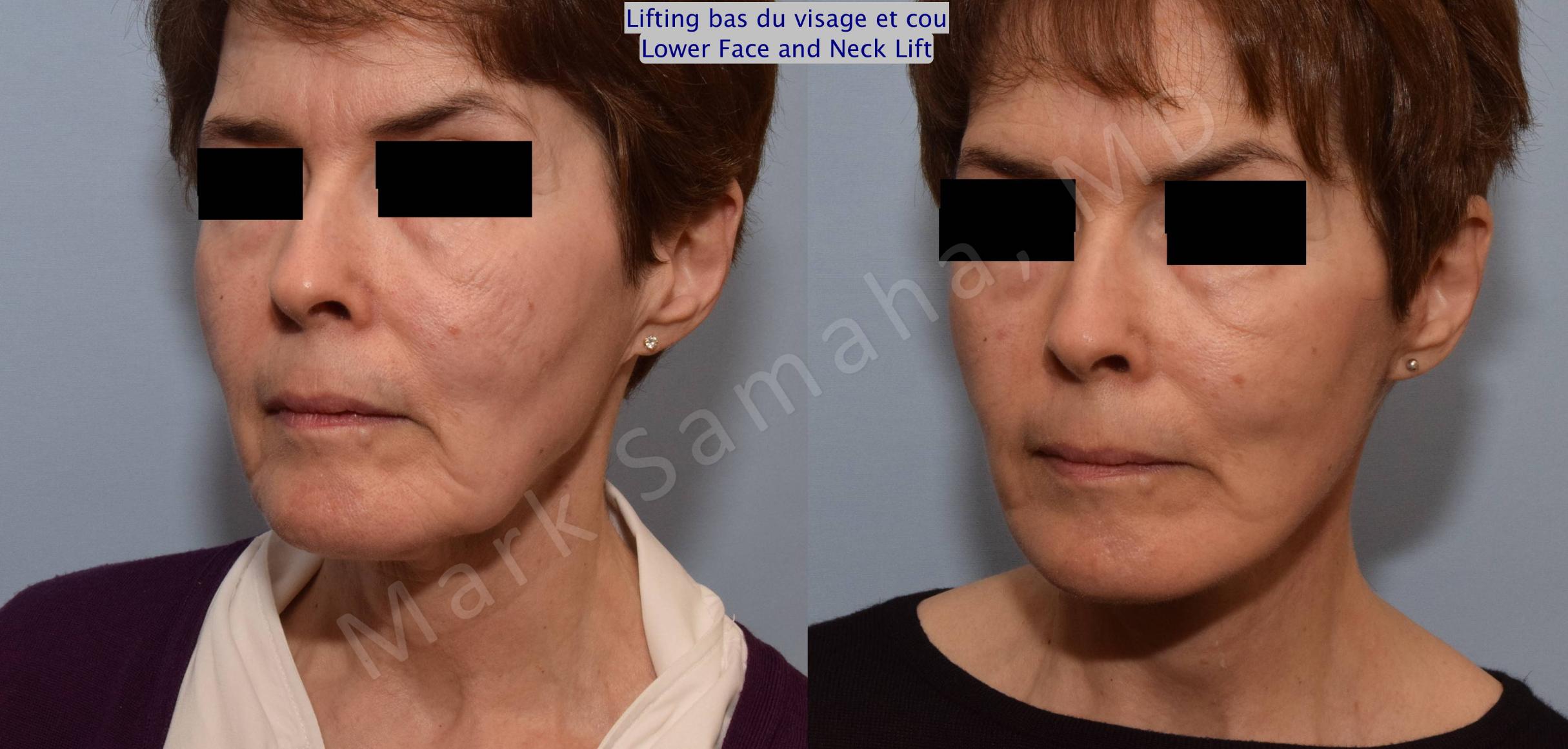 Before & After Lifting du visage / Cou - Facelift / Necklift Case 66 View #4 View in Mount Royal, QC
