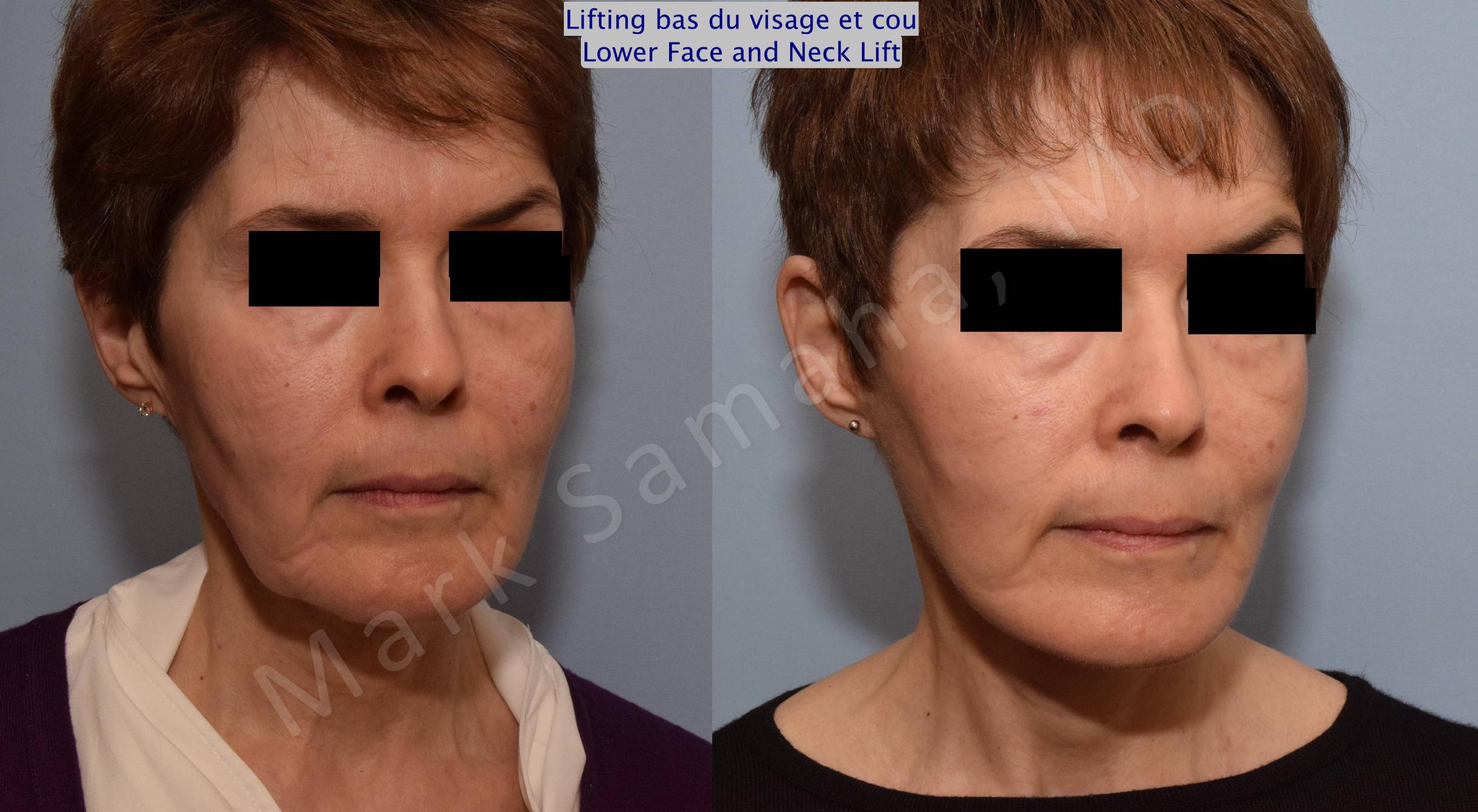 Before & After Lifting du visage / Cou - Facelift / Necklift Case 66 View #5 View in Mount Royal, QC