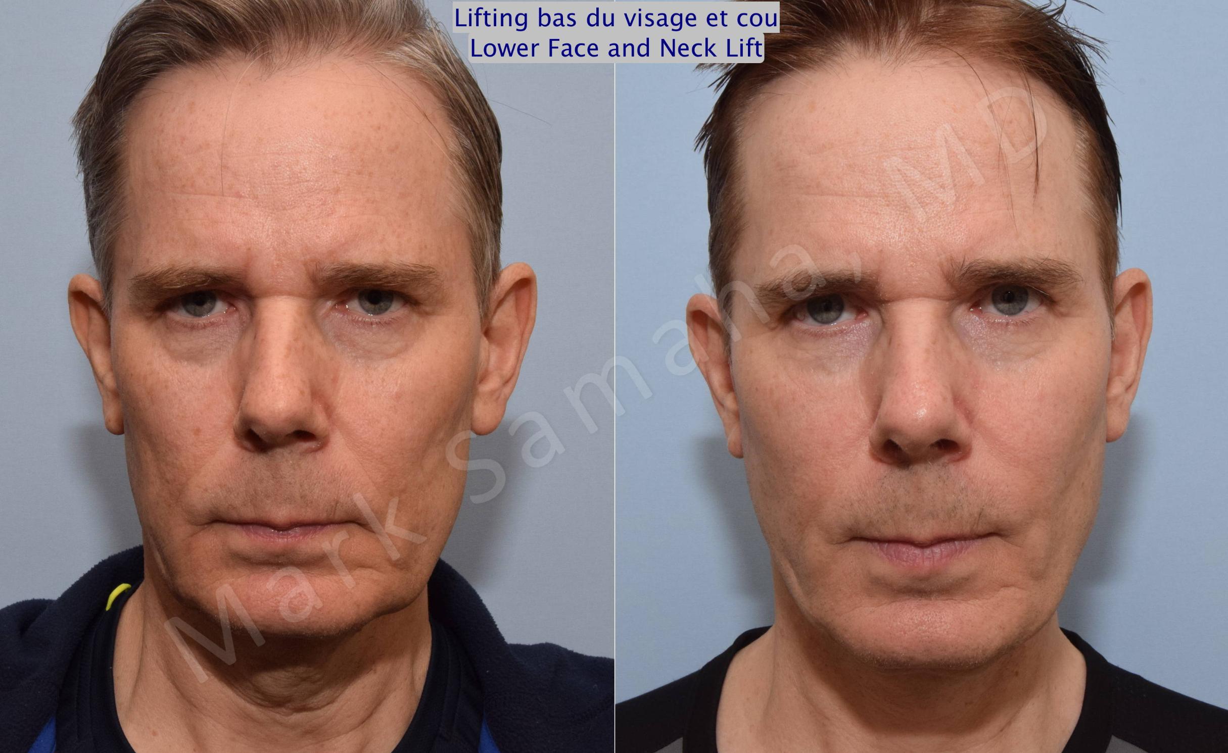 Before & After Facelift / Necklift - Lifting du visage / Cou Case 67 View #1 View in Mount Royal, QC