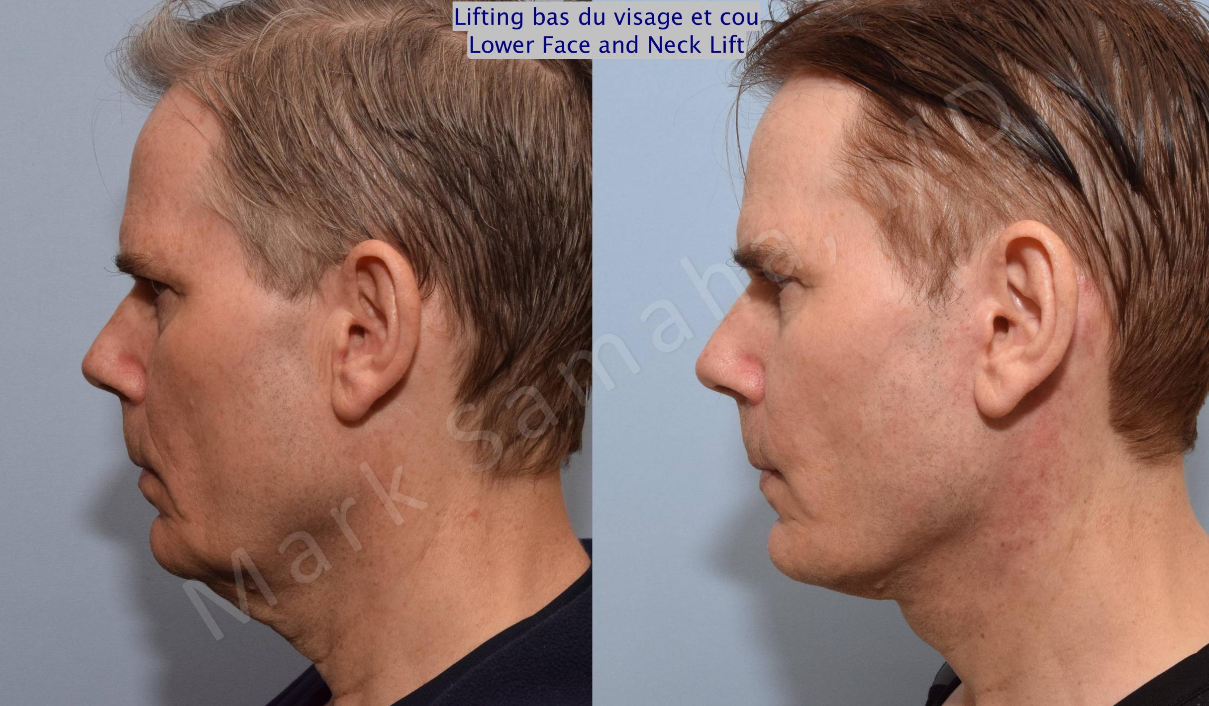 Before & After Facelift / Necklift - Lifting du visage / Cou Case 67 View #2 View in Mount Royal, QC