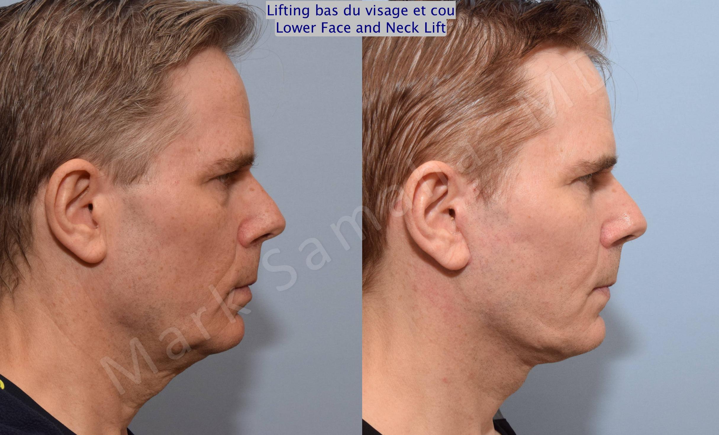 Before & After Facelift / Necklift - Lifting du visage / Cou Case 67 View #3 View in Mount Royal, QC