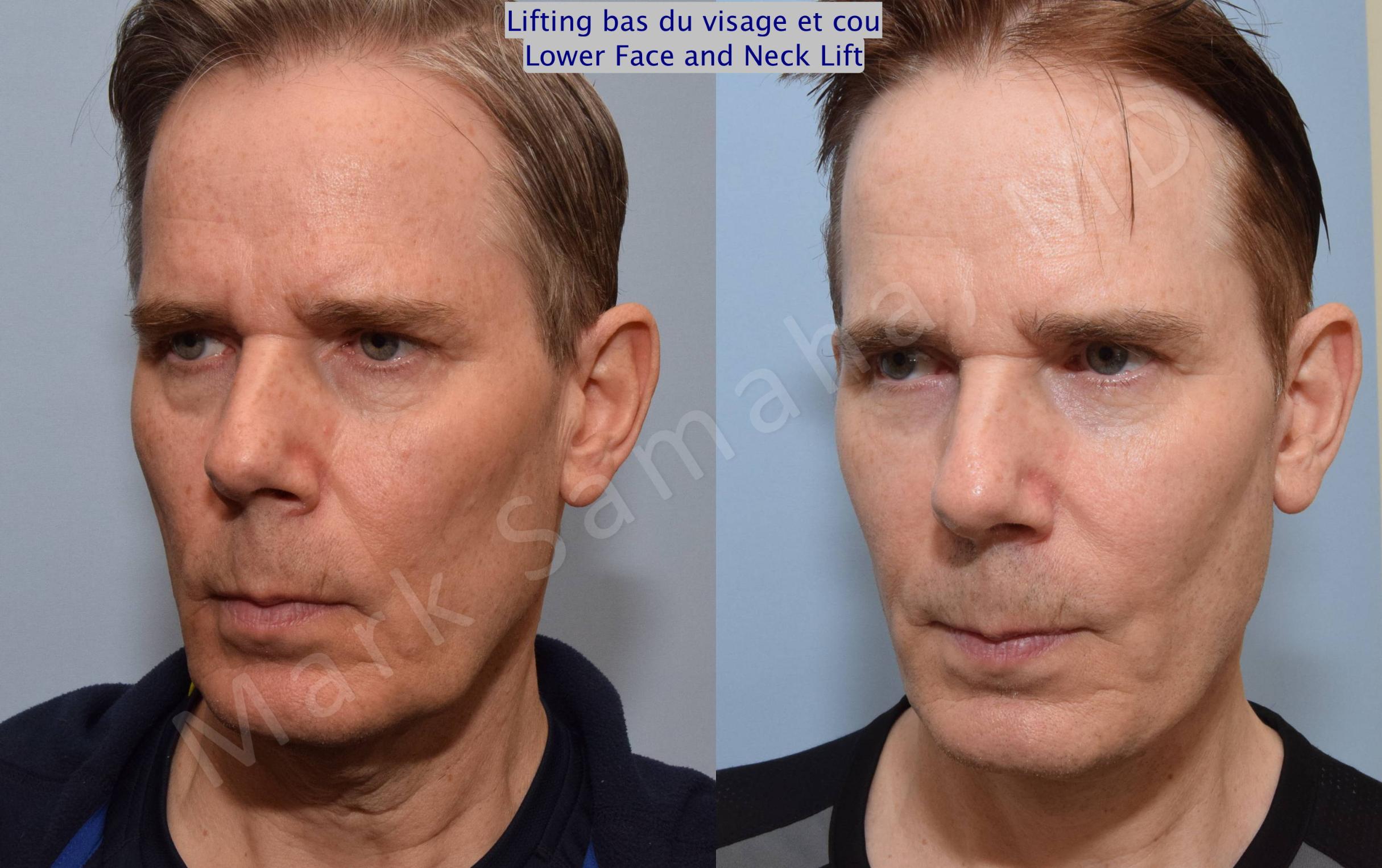 Before & After Facelift / Necklift - Lifting du visage / Cou Case 67 View #4 View in Mount Royal, QC