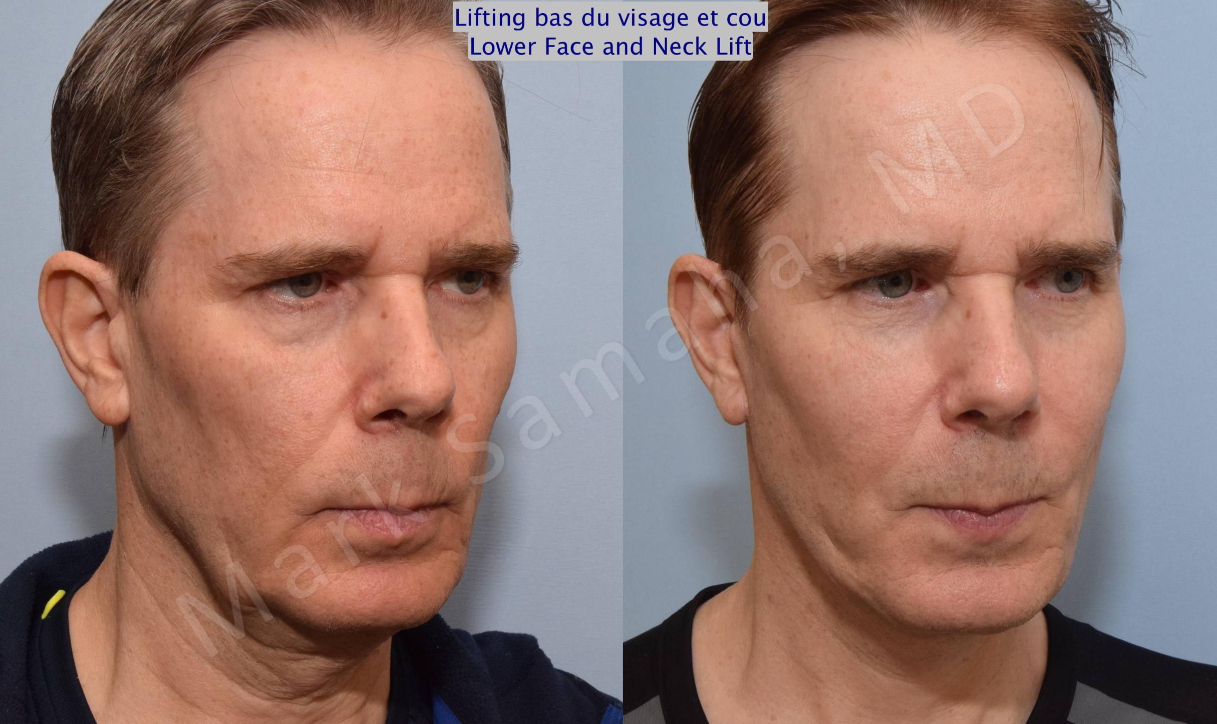Before & After Facelift / Necklift - Lifting du visage / Cou Case 67 View #5 View in Mount Royal, QC