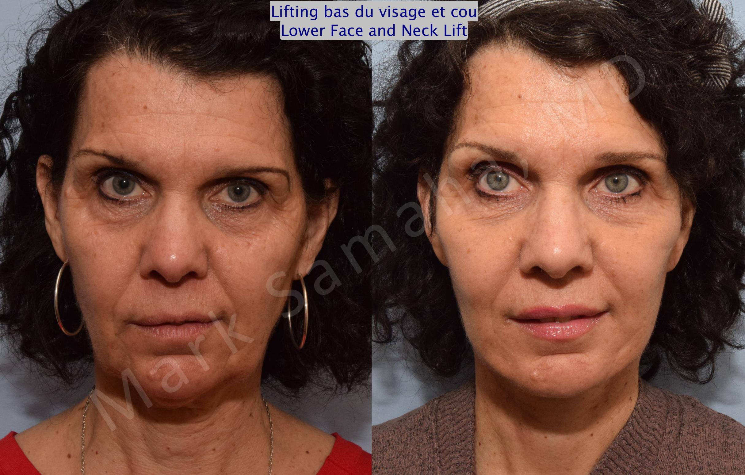 Before & After Facelift / Necklift - Lifting du visage / Cou Case 68 View #1 View in Mount Royal, QC