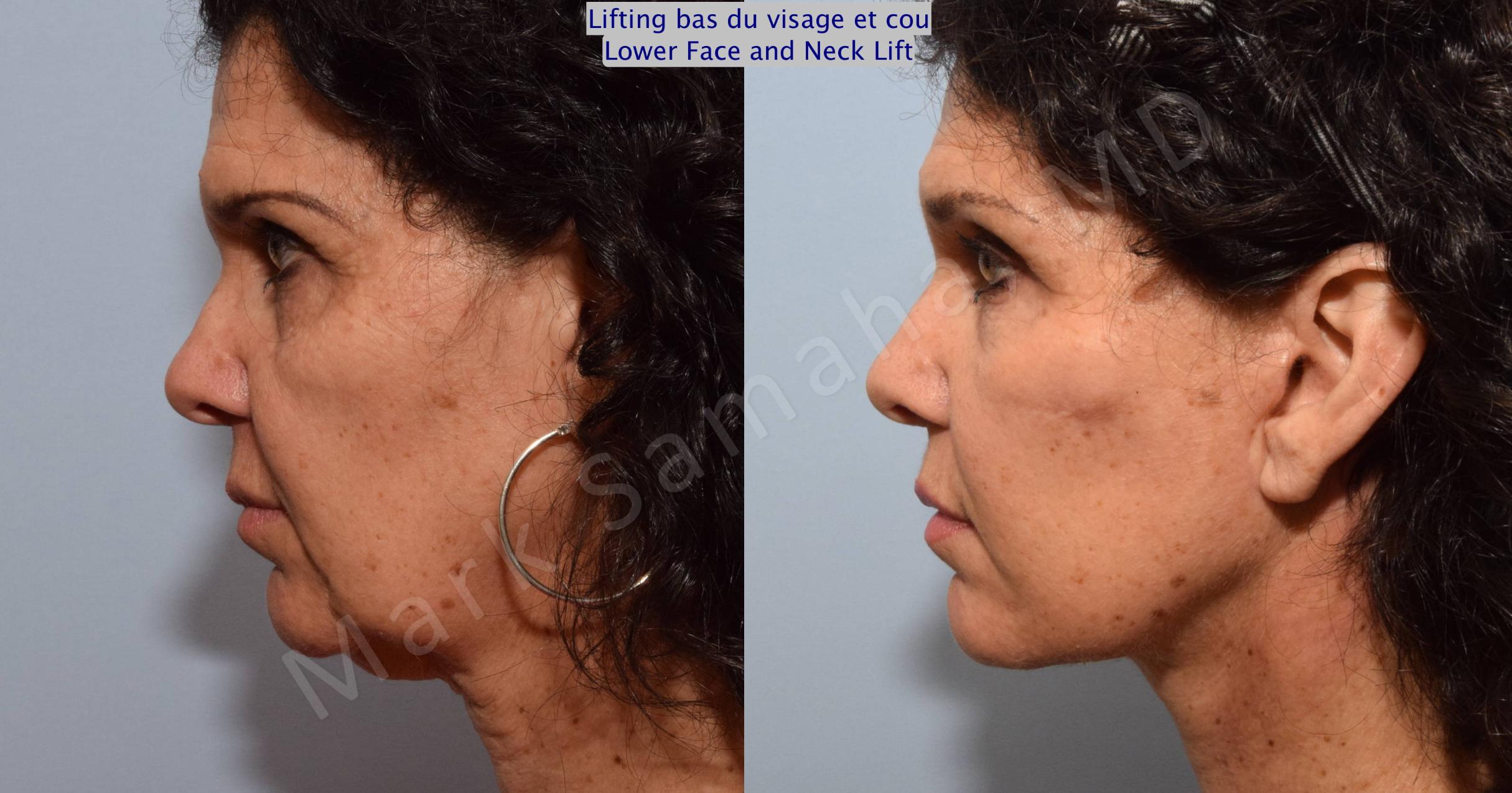 Before & After Facelift / Necklift - Lifting du visage / Cou Case 68 View #3 View in Mount Royal, QC