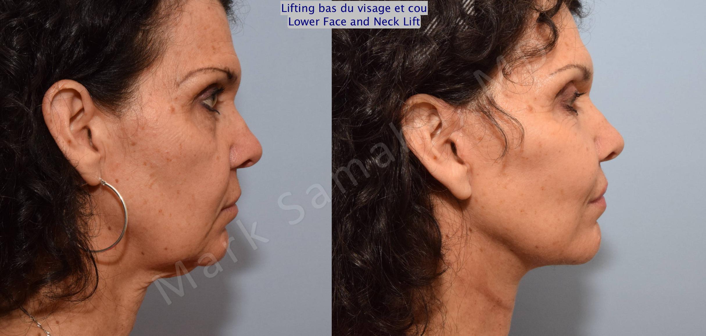 Before & After Facelift / Necklift - Lifting du visage / Cou Case 68 View #4 View in Mount Royal, QC